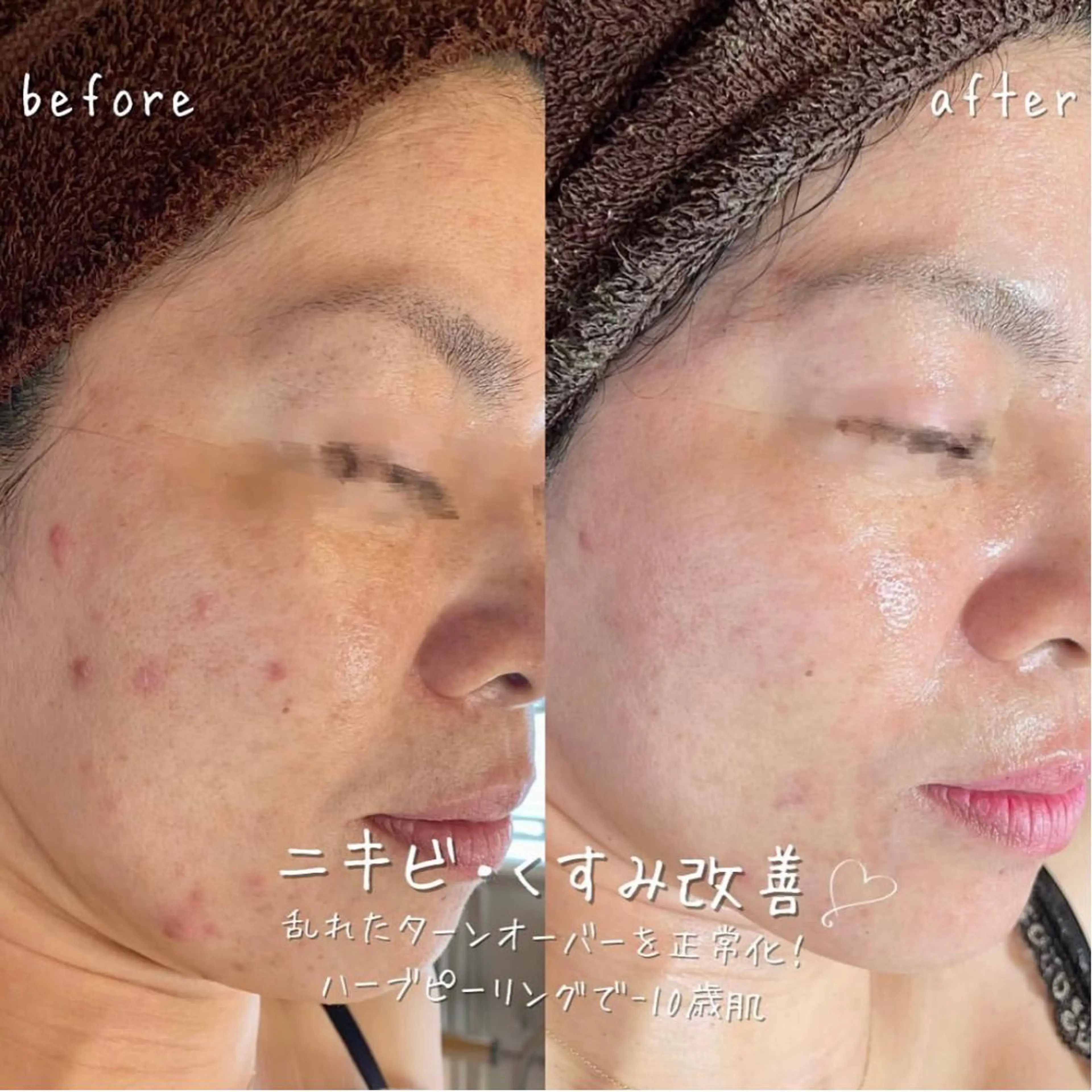 エステ 【ハーブピーリング/毛穴洗浄】NA skin 川崎店〜ニキビ・毛穴専門店〜所属・NAskin川崎 皆川のエステ・リラクイメージ