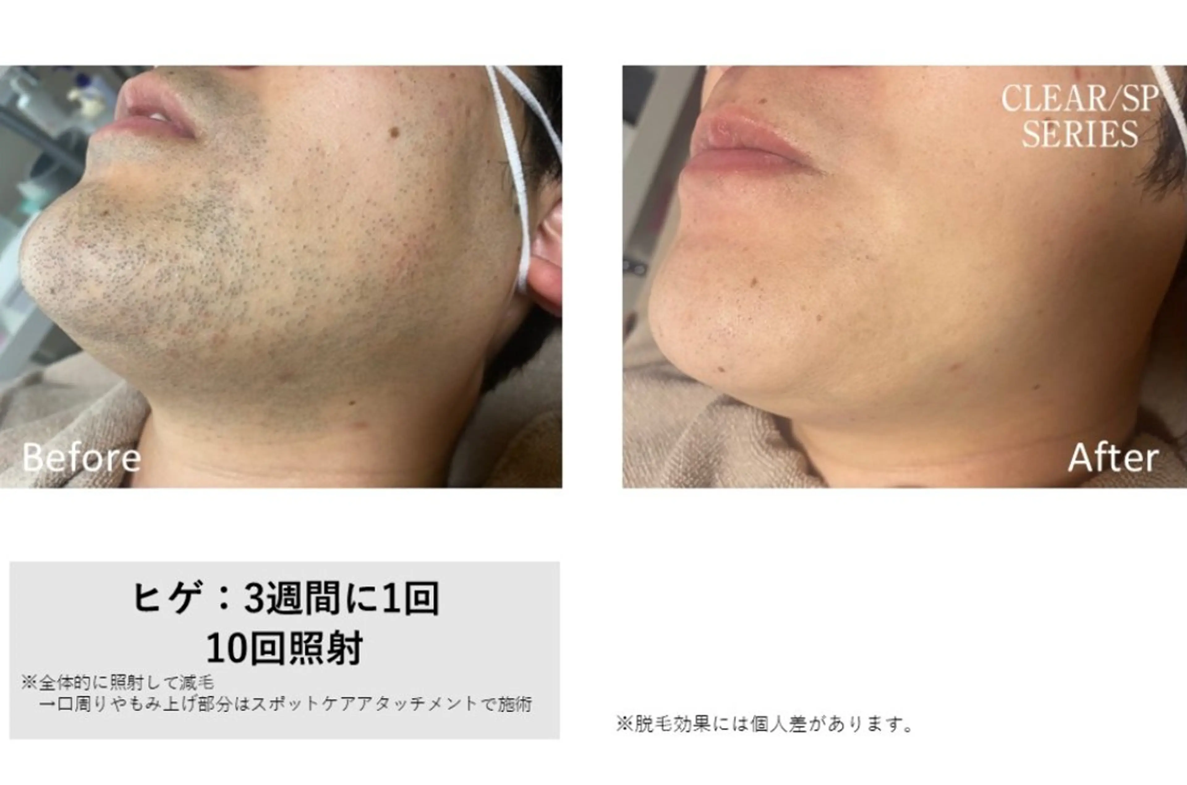 【国内産】NBS美容全身脱毛《お髭》（体験から本格へ）の写真