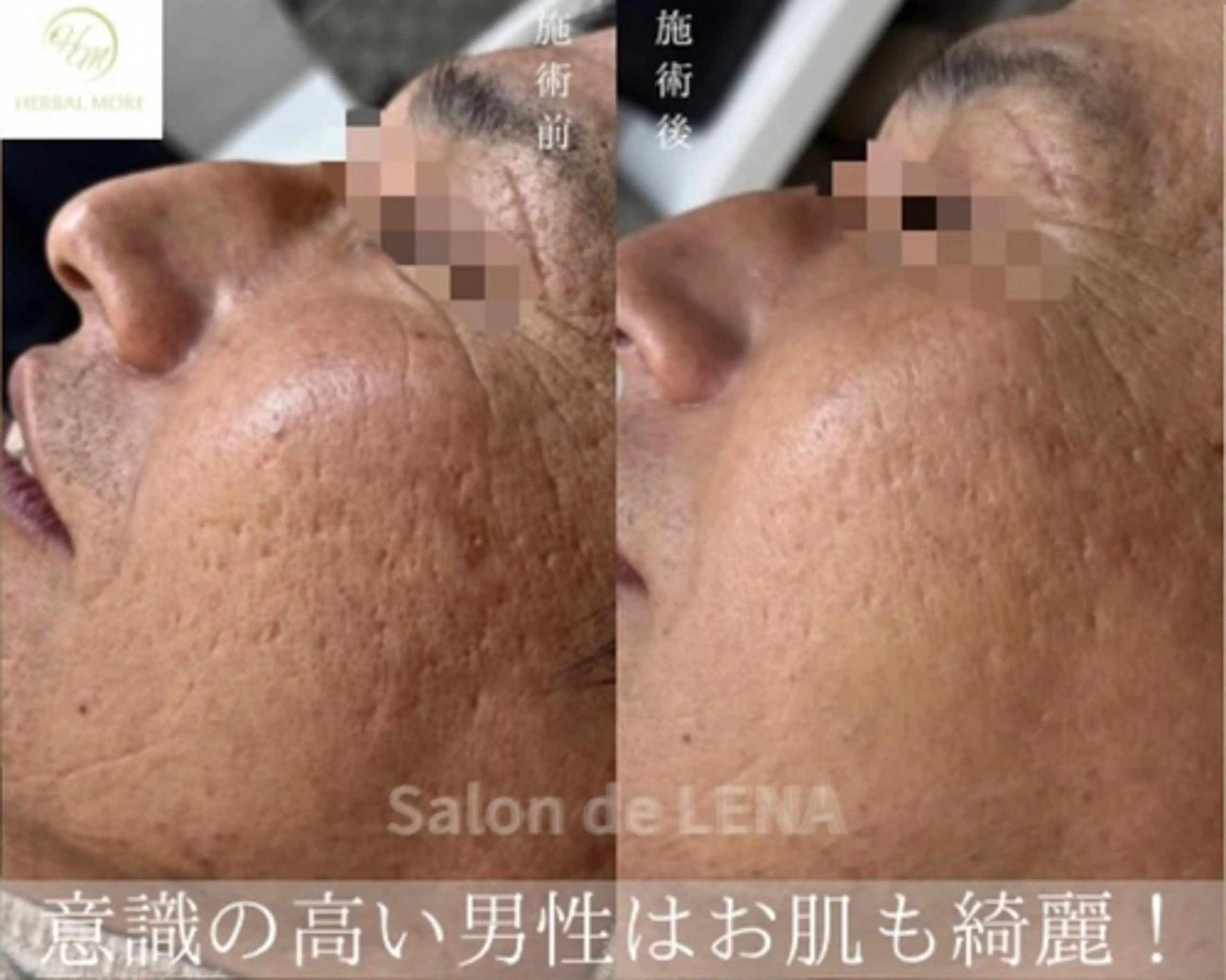 ハーブピーリング・毛穴ケア専門サロンSalon de LENA 栄店所属・ハーブピーリング専門 サロンドレナ　白藤のエステ・リラクイメージ