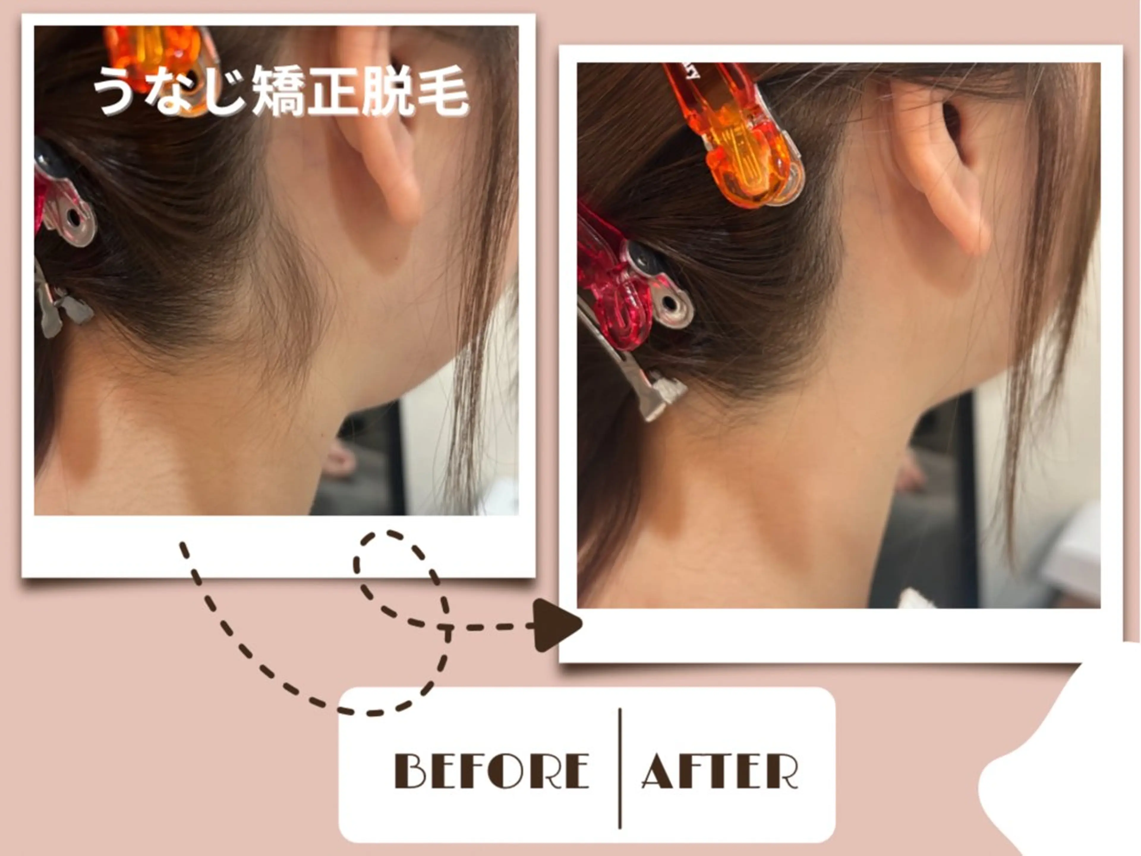 【11月限定◇SNSで話題】\うなじ矯正脱毛/¥6,160→¥3,960の写真