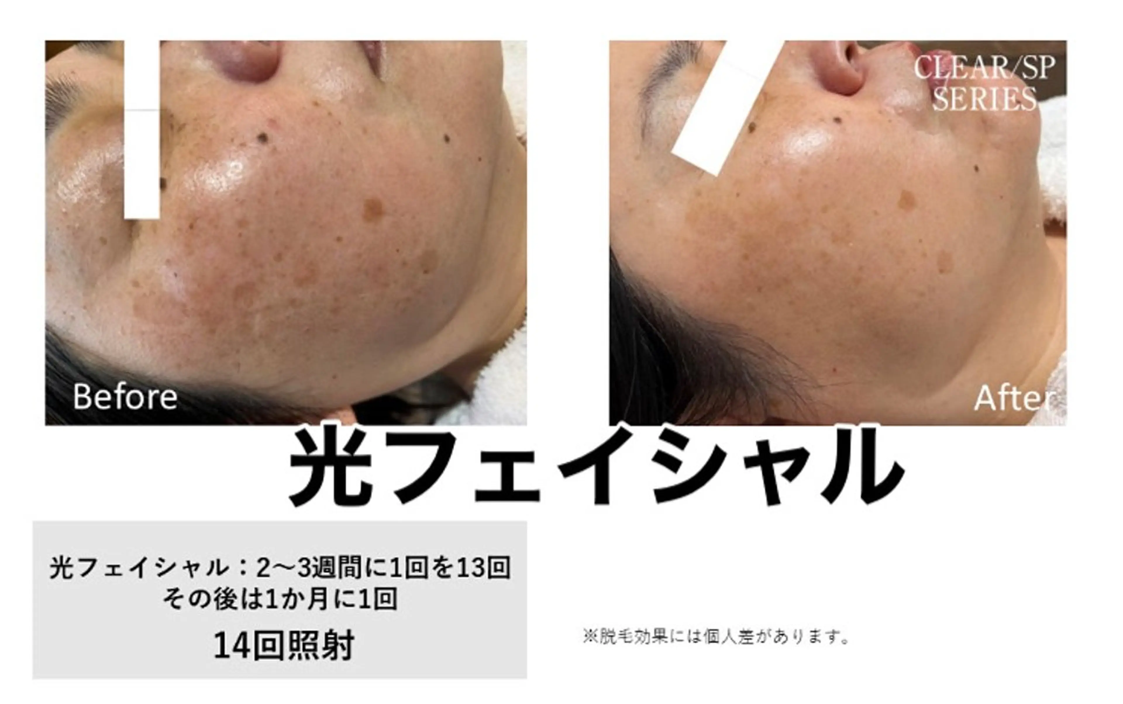 光フェイシャルの写真