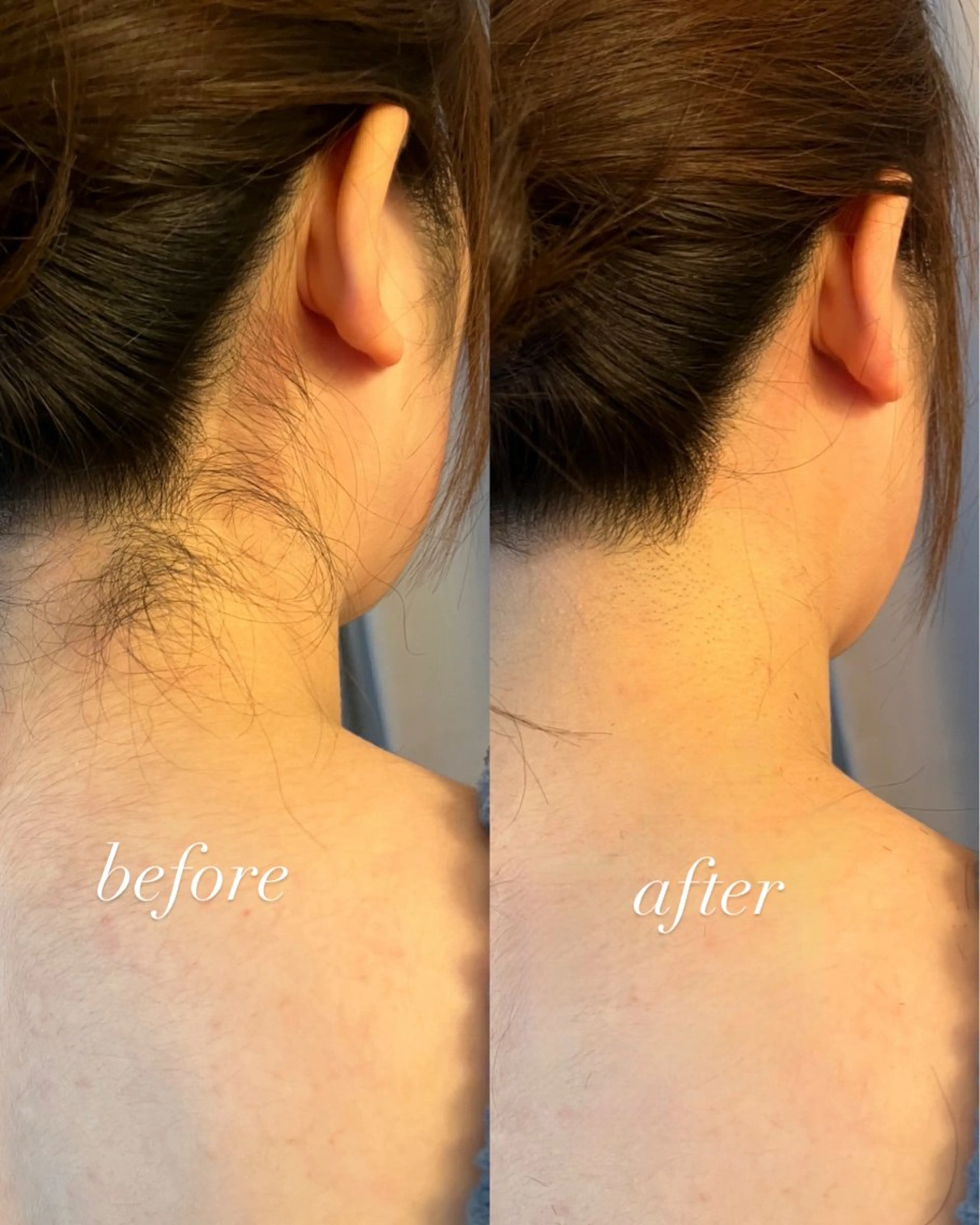 脱毛 うなじ脱毛/美肌脱毛 LABELのエステ・リラクイメージ