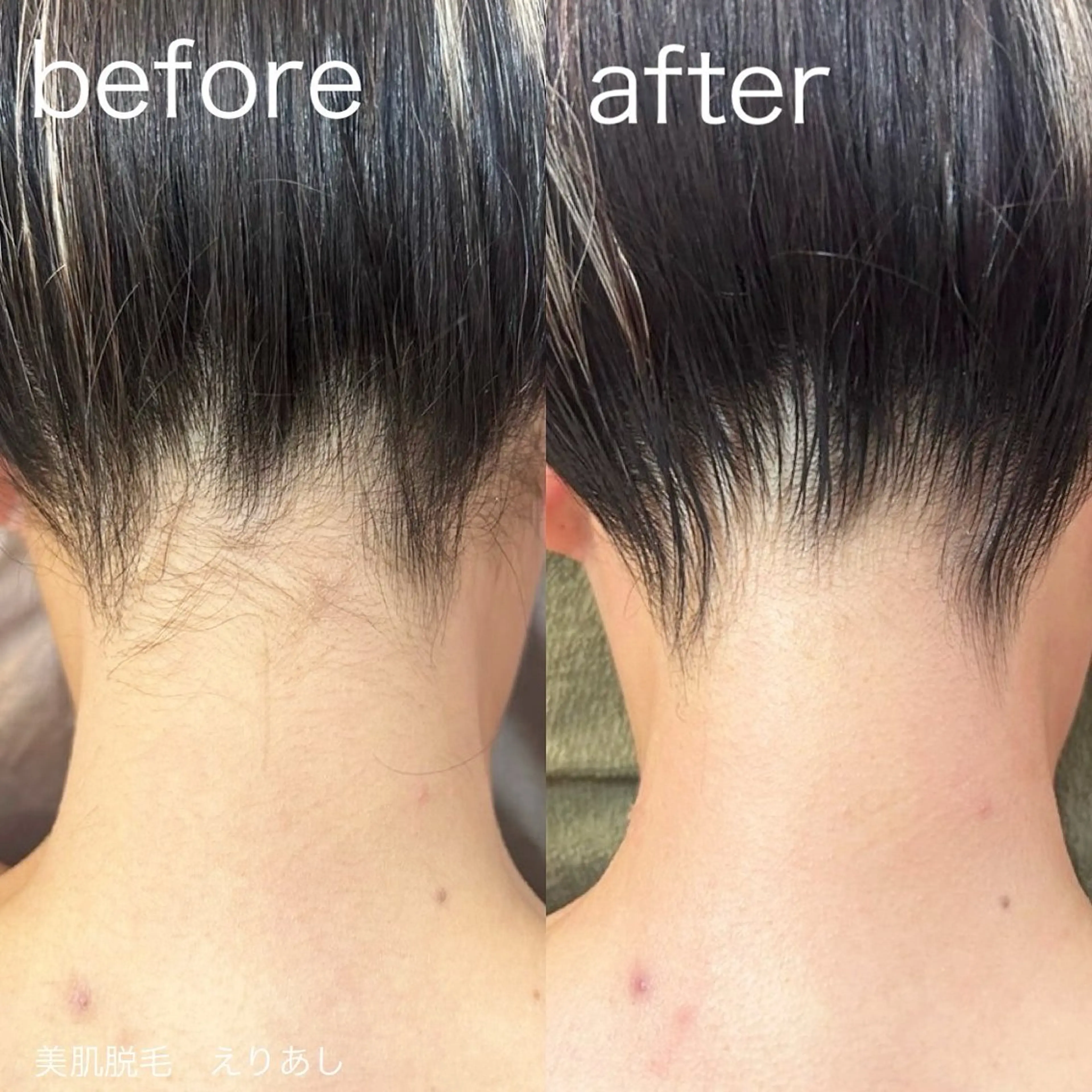 【成人式特別メニュー✨】うなじ＋背中上脱毛【学割U24】の写真