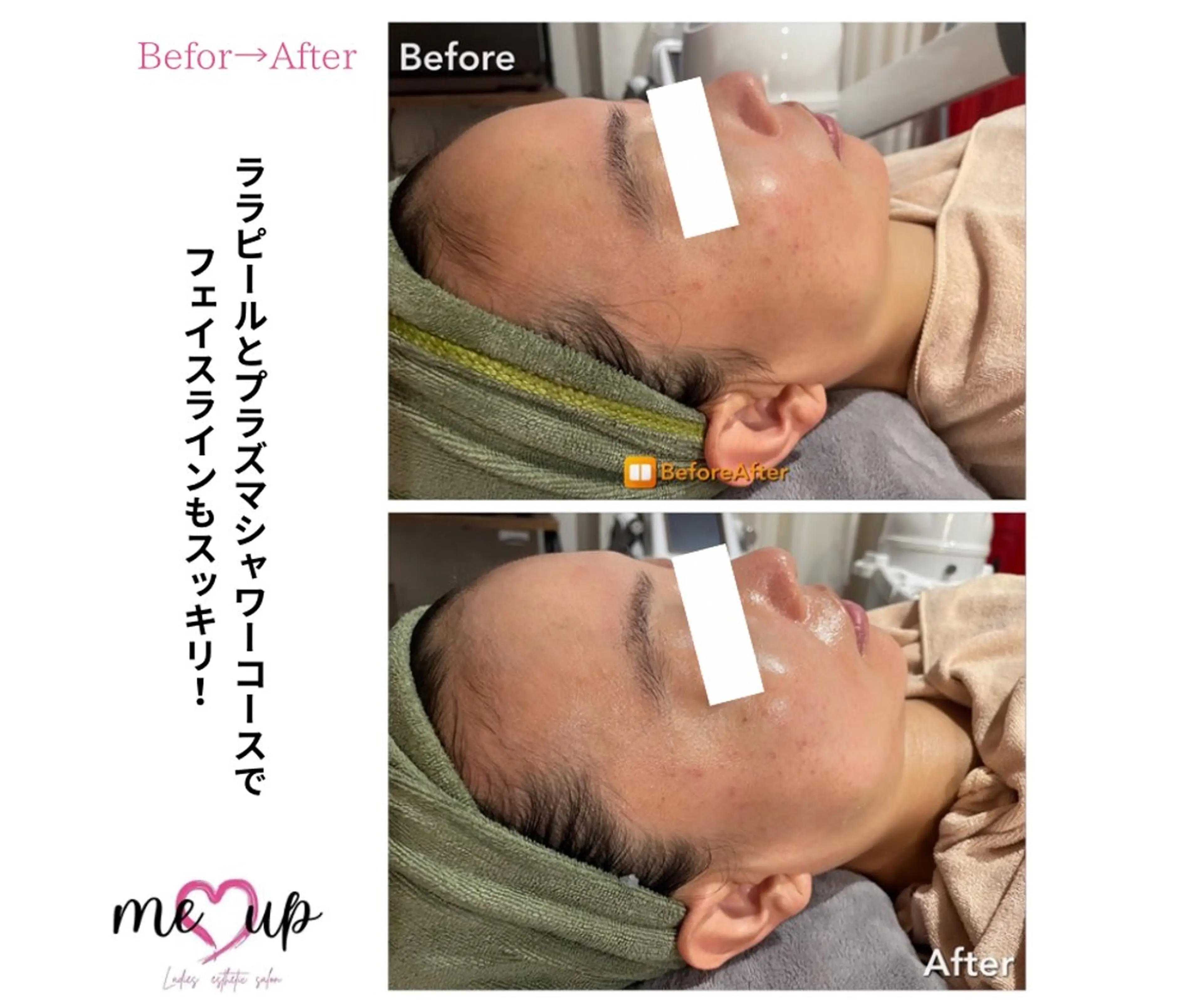 エステ Meupニキビ専門店 背中/ハーブ/ララのその他イメージ