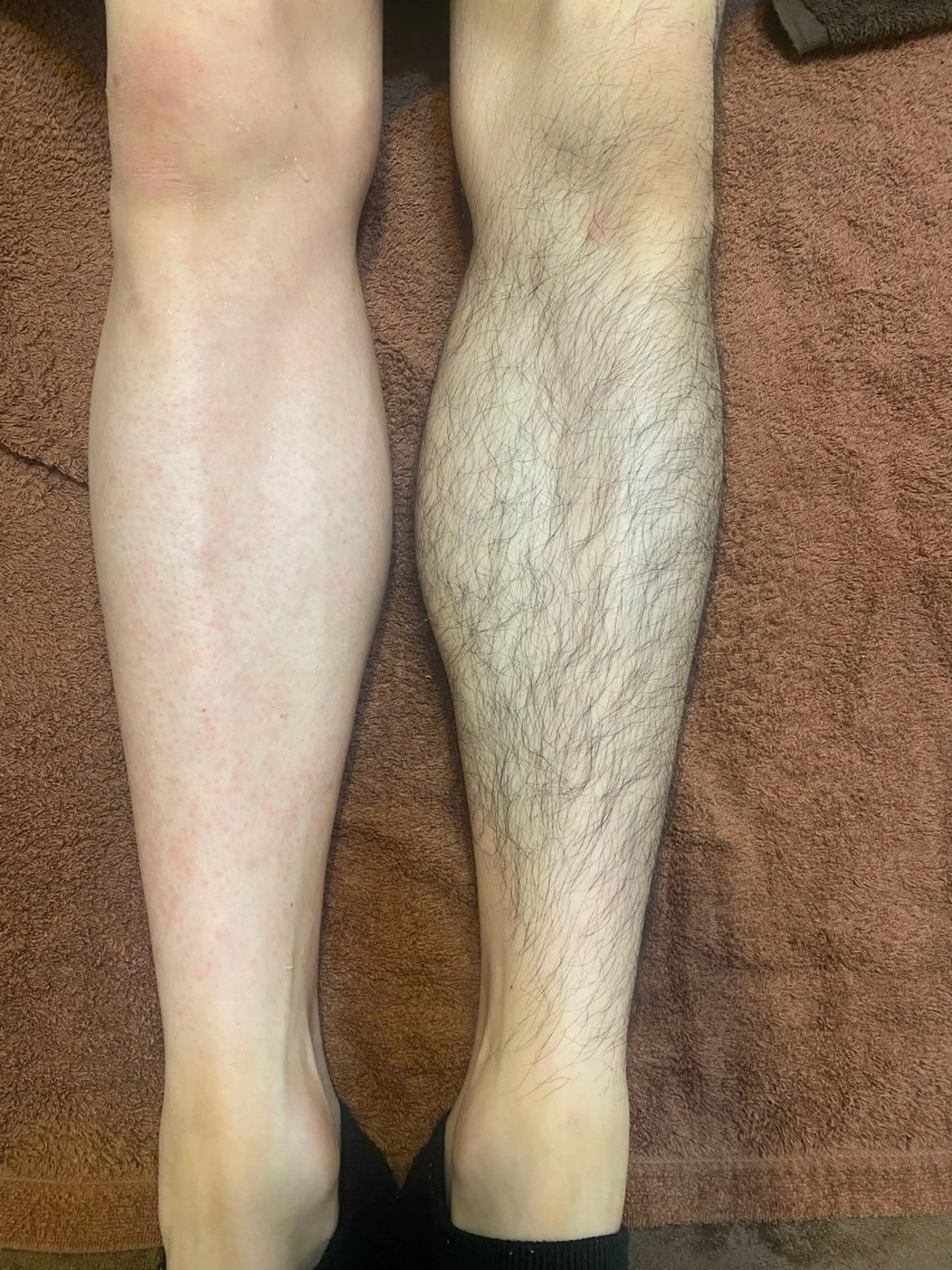 《男性》【清潔感UP✨】メンズひざ＋ひざ下WAX脱毛🍯🦵ムレ・チクチク対策にも◎の写真