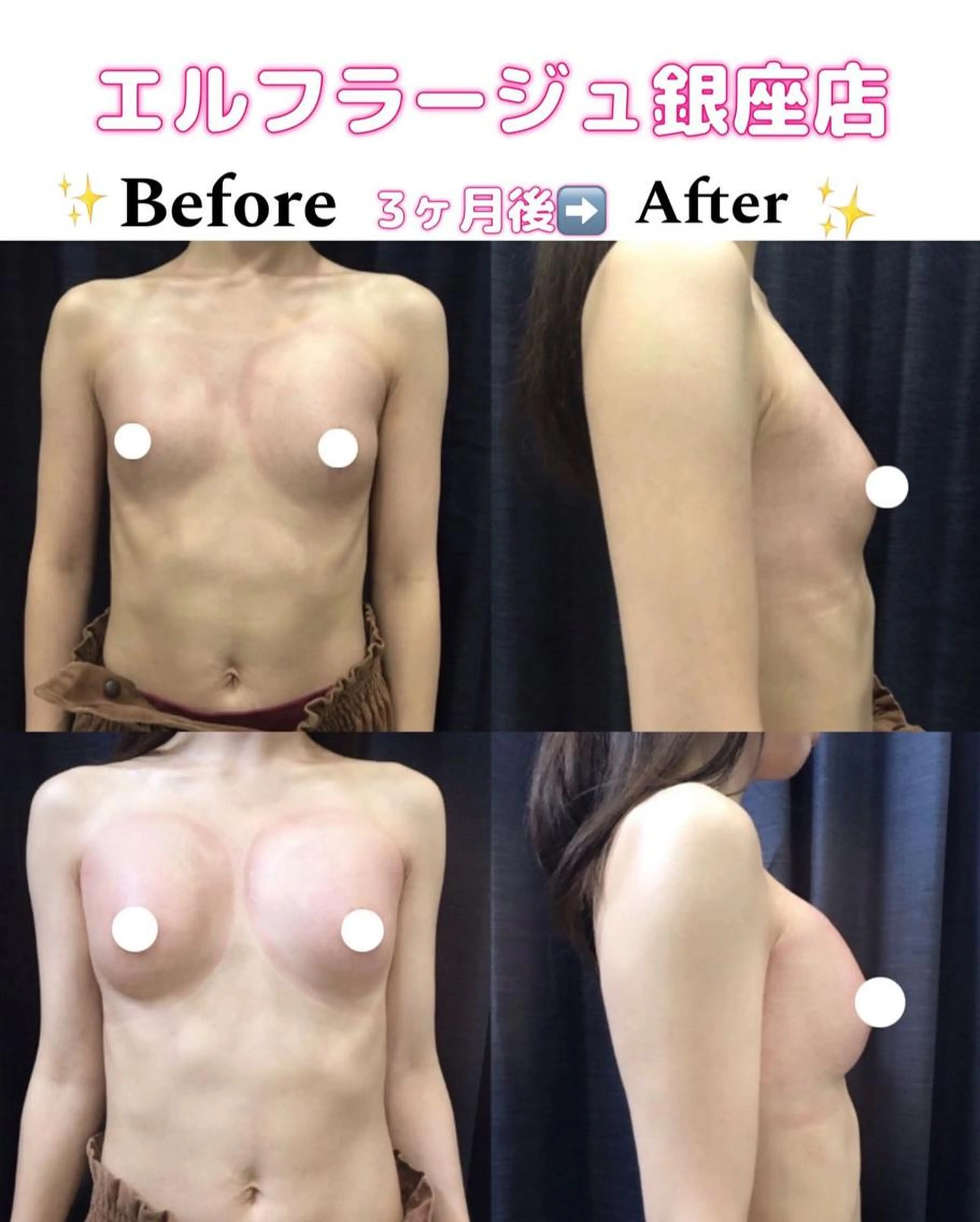 【✨💖キャンペーンNO2 形&ハリ重視💖✨】大好評につきビューティフルコース￥34,100→￥3,500の写真