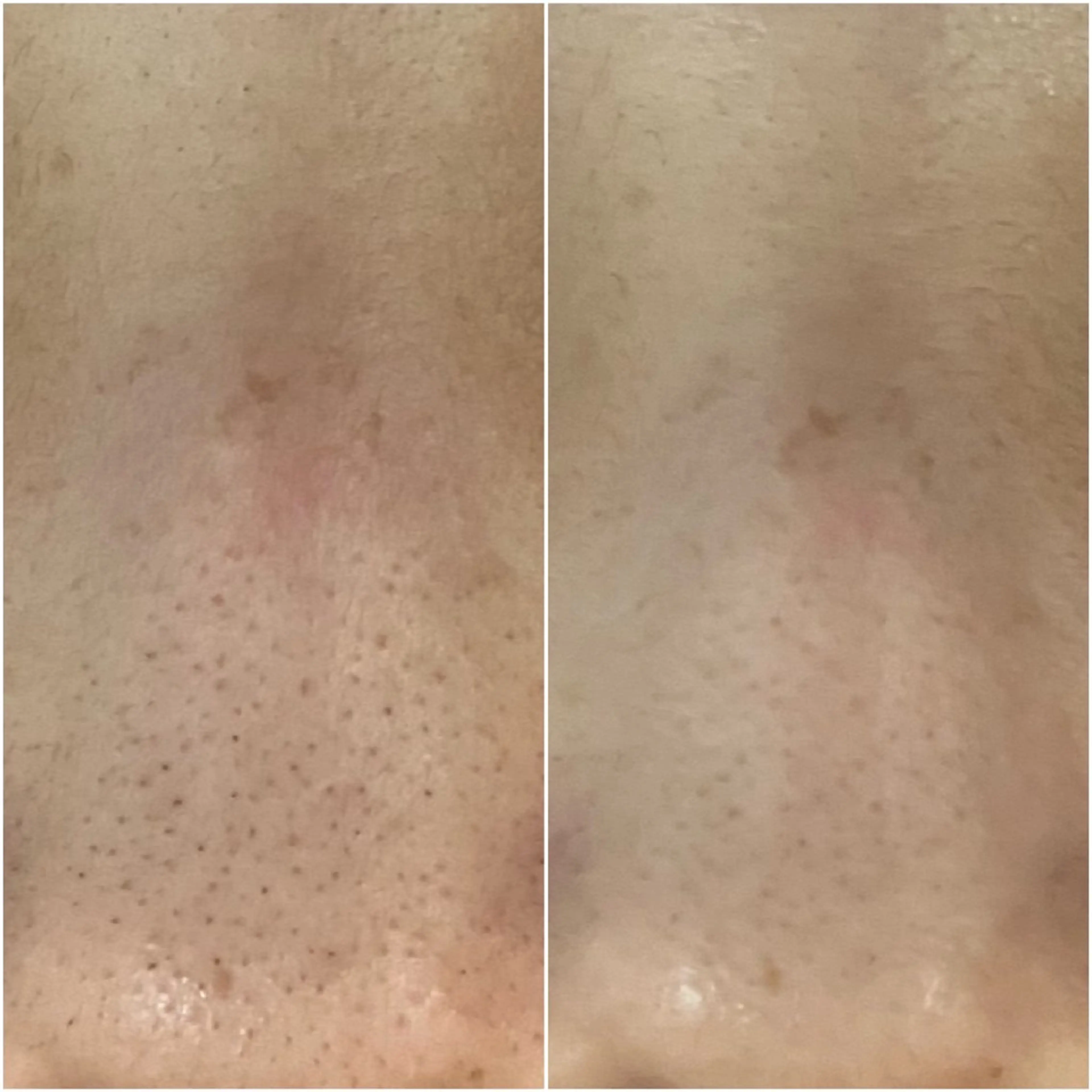 《毛穴の黒ずみ&ニキビケア》毛穴洗浄×ハーブピーリング 80分 デコルテ＆ショルダー＆ヘッドマッサージ付の写真