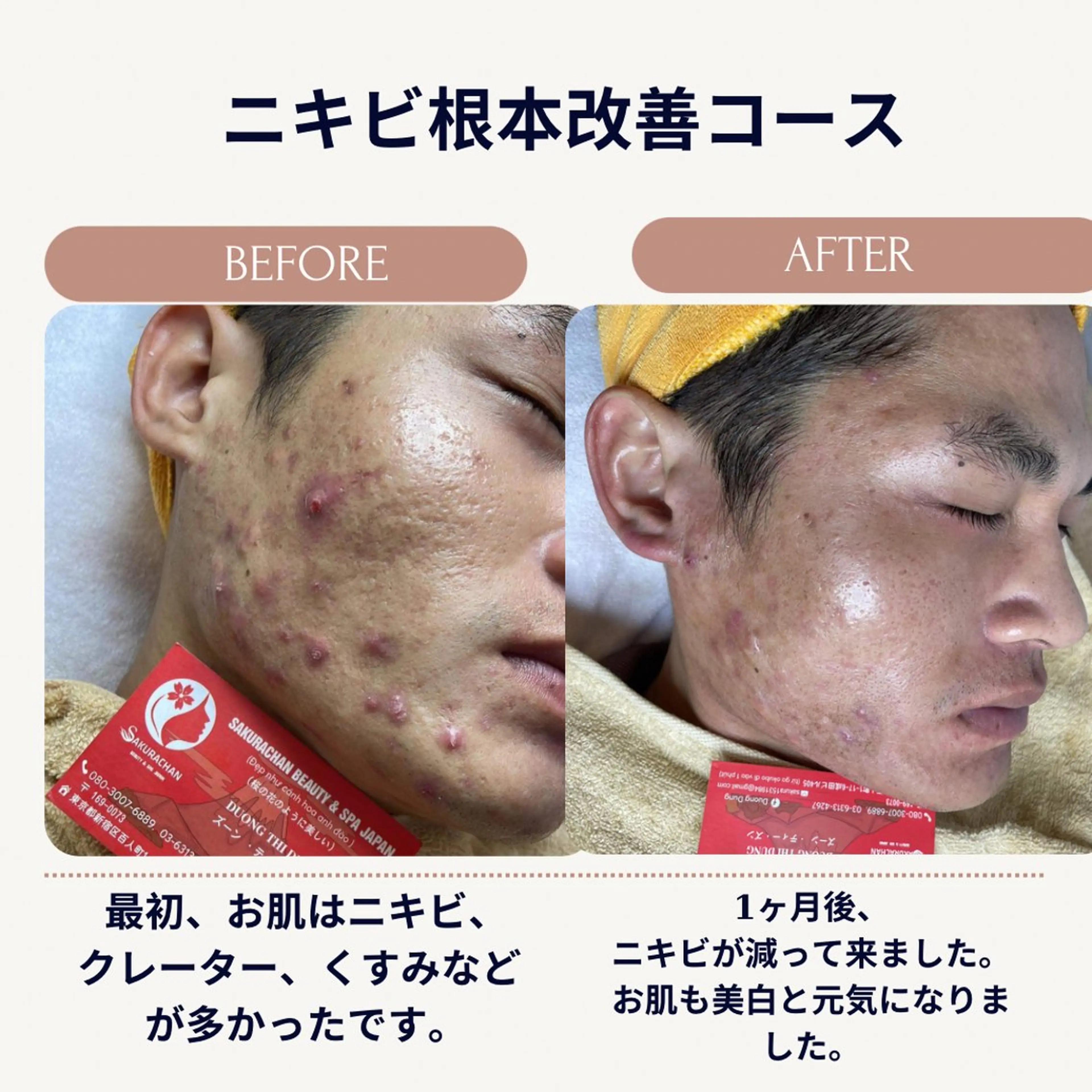 ニキビ、痩身、脱毛、 サクラチャンスパのエステ・リラクイメージ