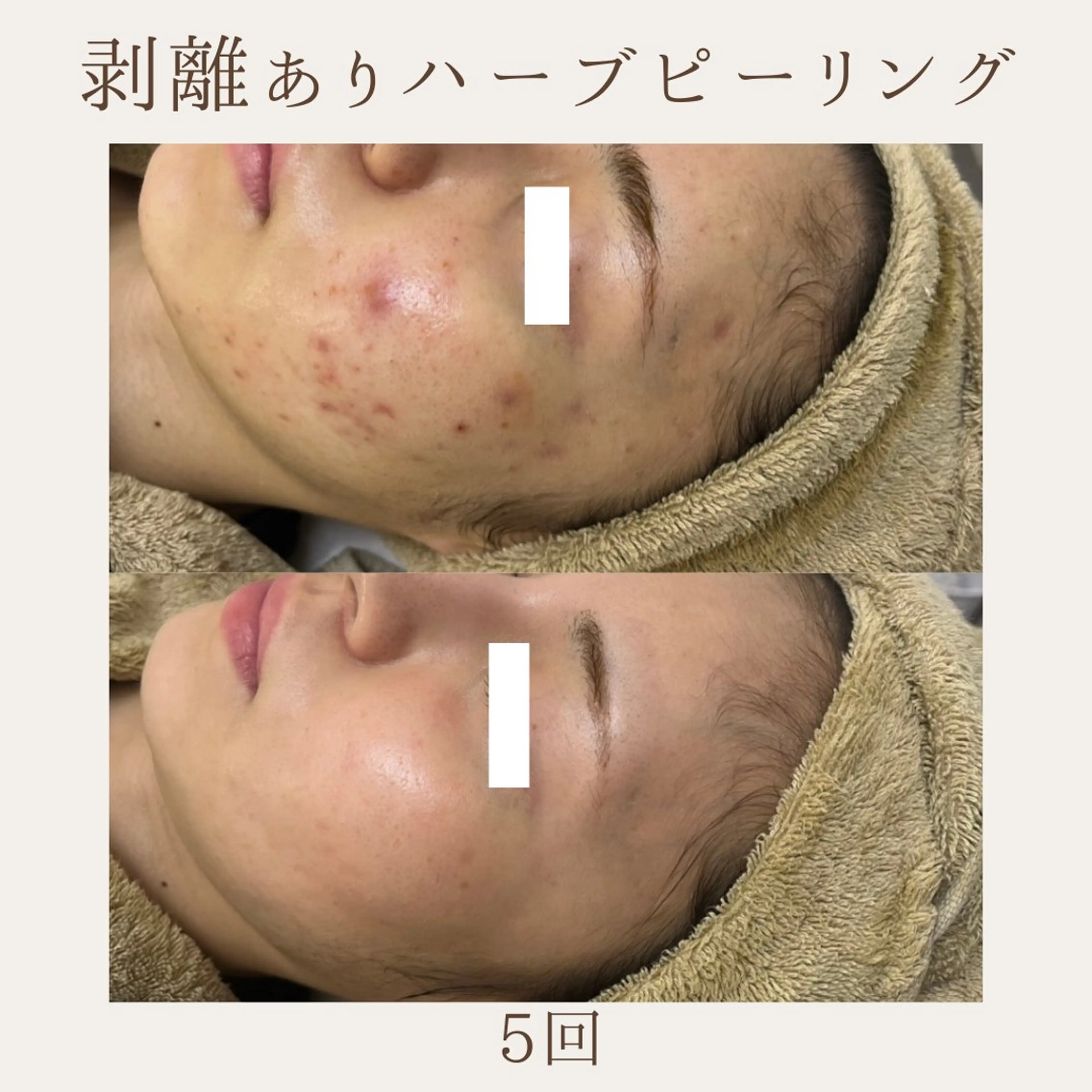 エステ 肌質改善サロン renew所属・肌質改善サロン renew/ｳｴｷのエステ・リラクイメージ