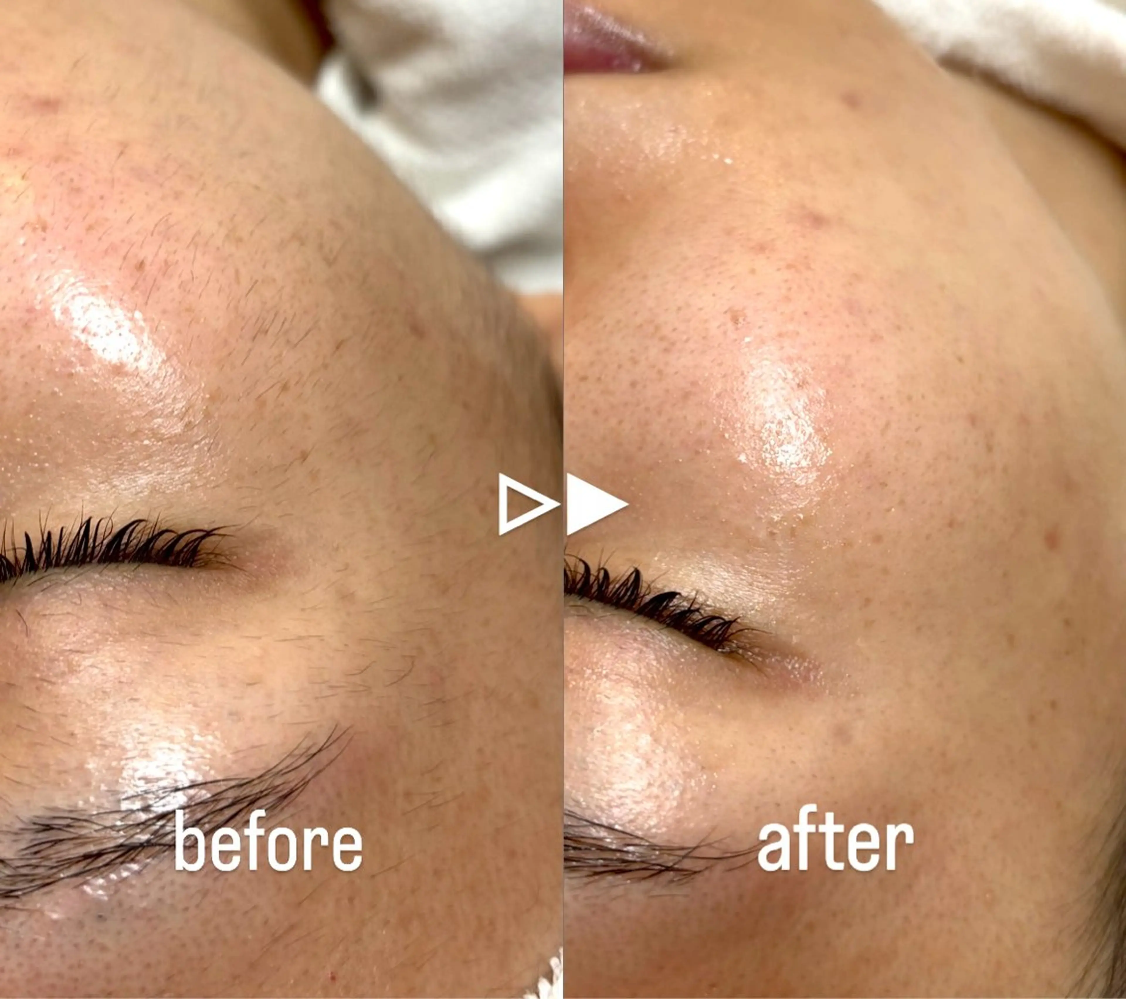 【モデル】[詳細必読]レディースお顔シェービングの写真