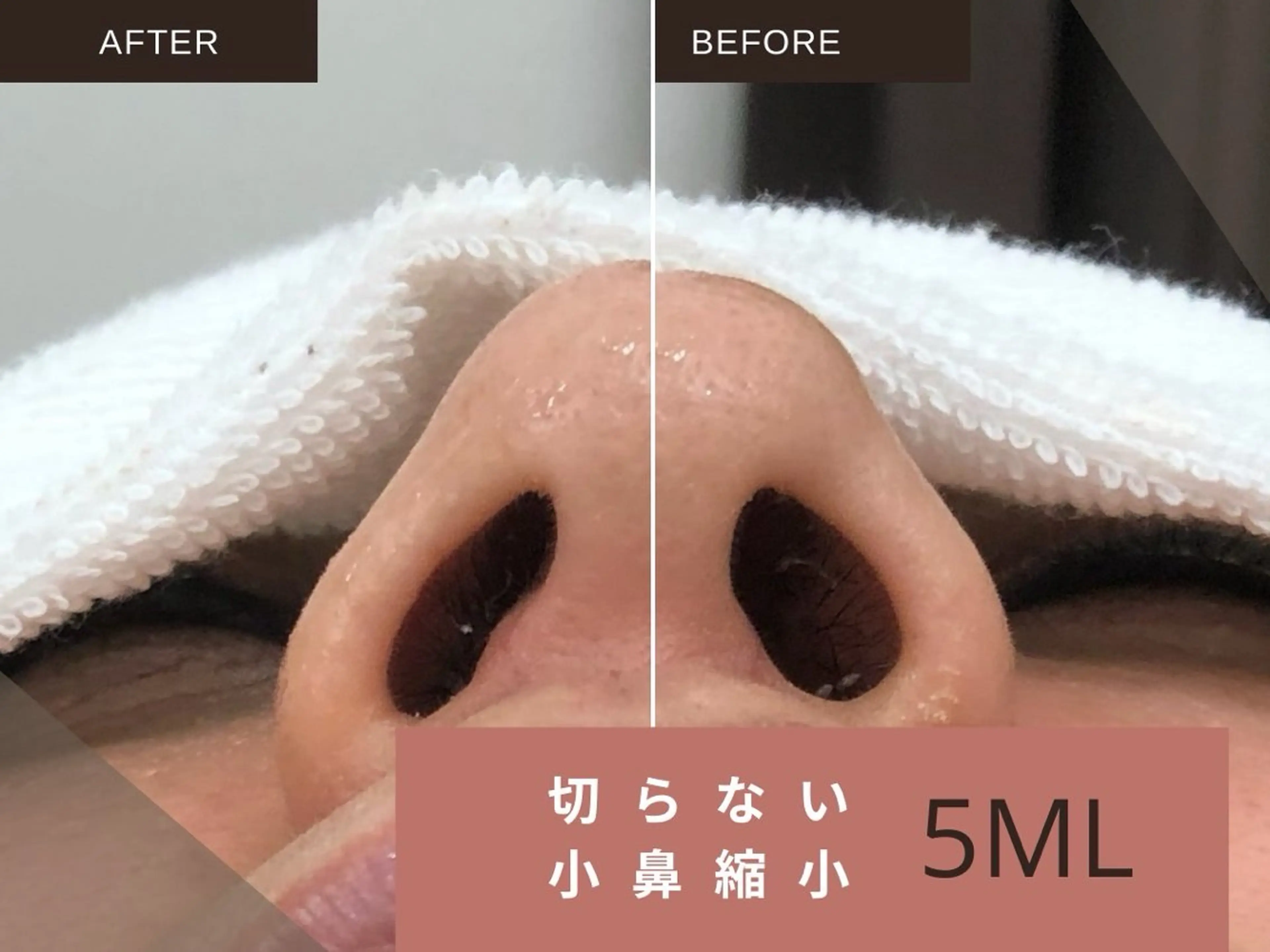 【人気No.2】小鼻縮小/クマとり/瞼の厚みなどに!脂肪撃退プロ5mlメンズ🆗✨の写真