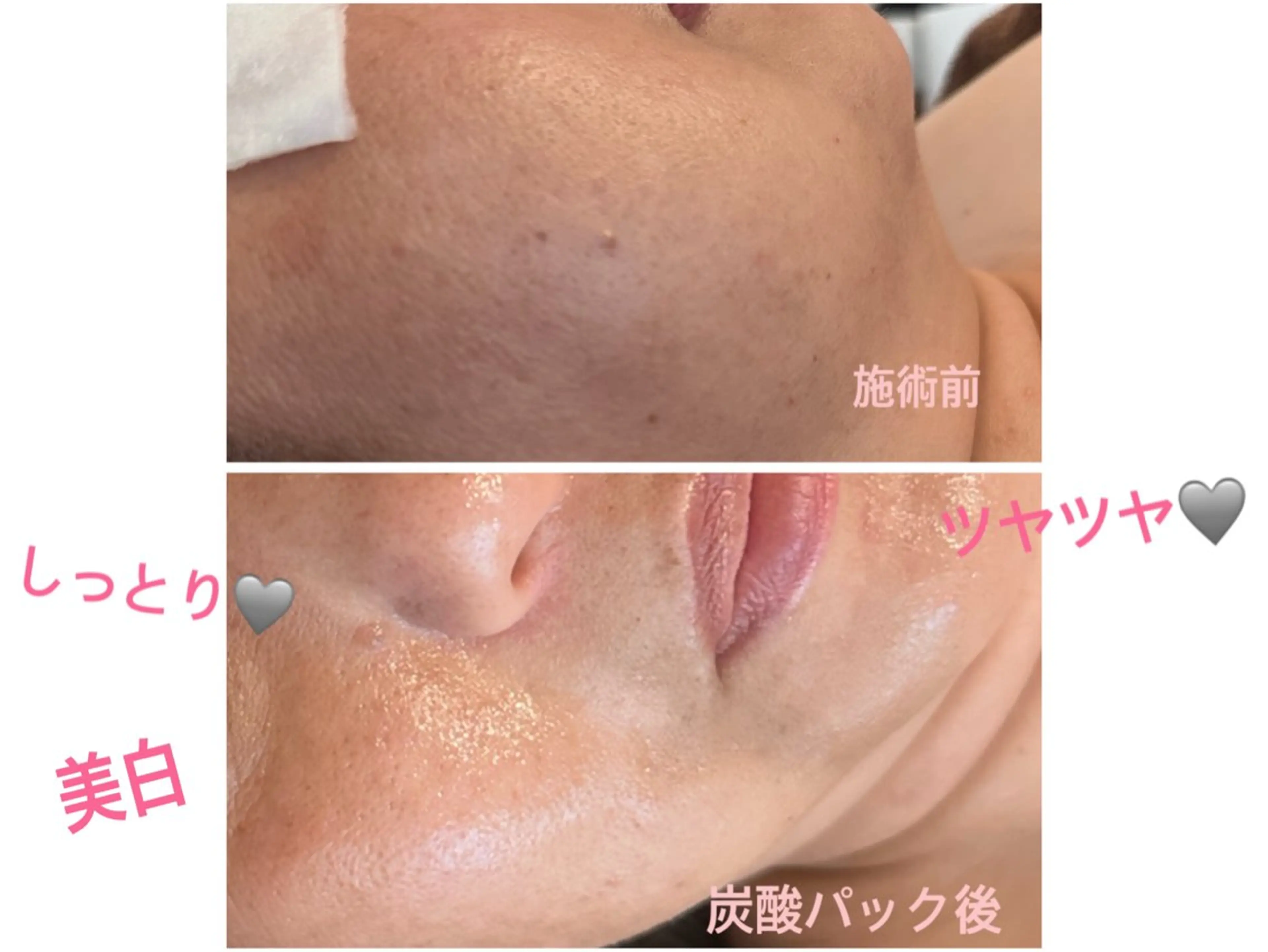 潤いたっぷり！オールハンドフェイシャル＋デコルテケア💆🏼‍♀️炭酸パック付の写真