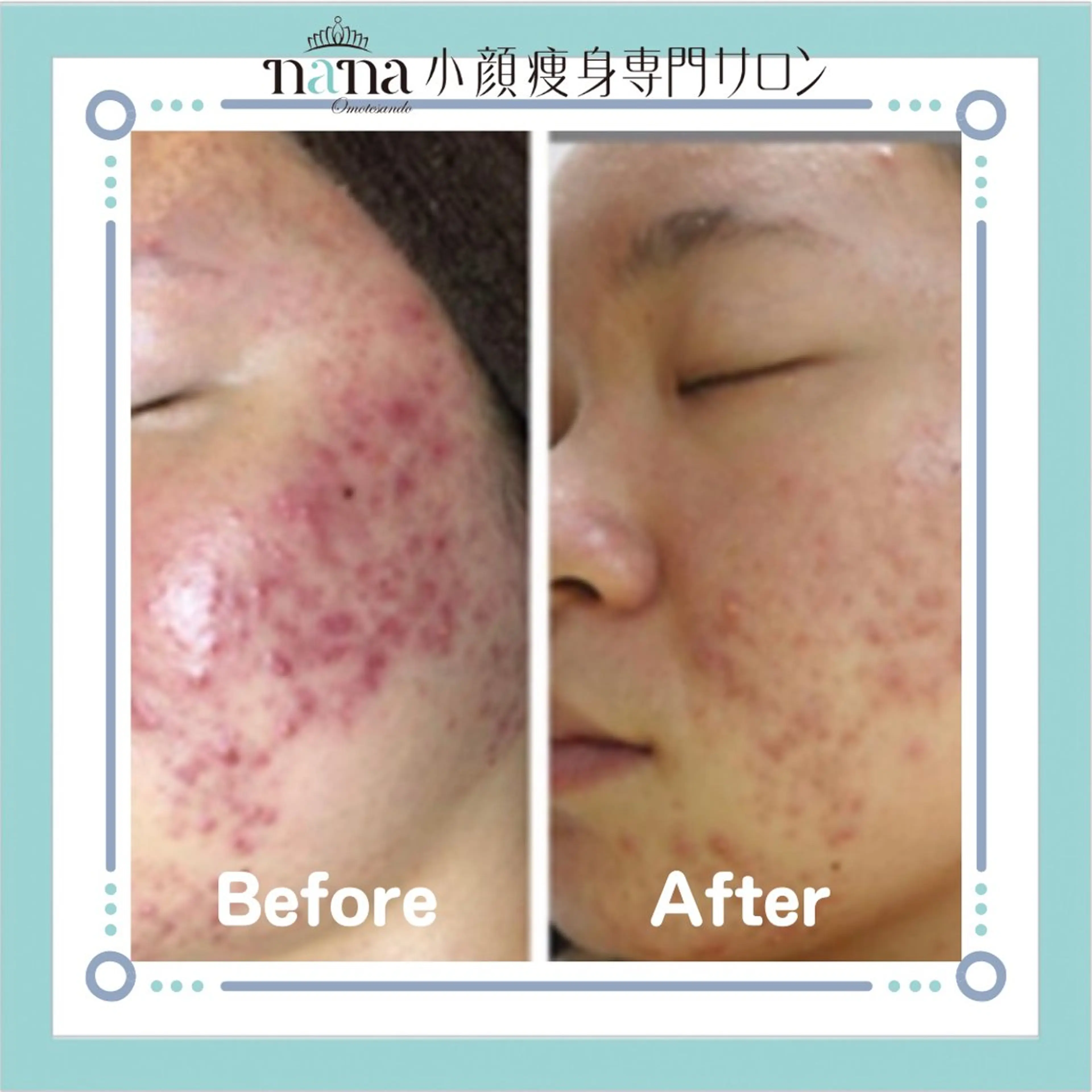 小顔痩身インディバ Nana表参道のエステ・リラクイメージ