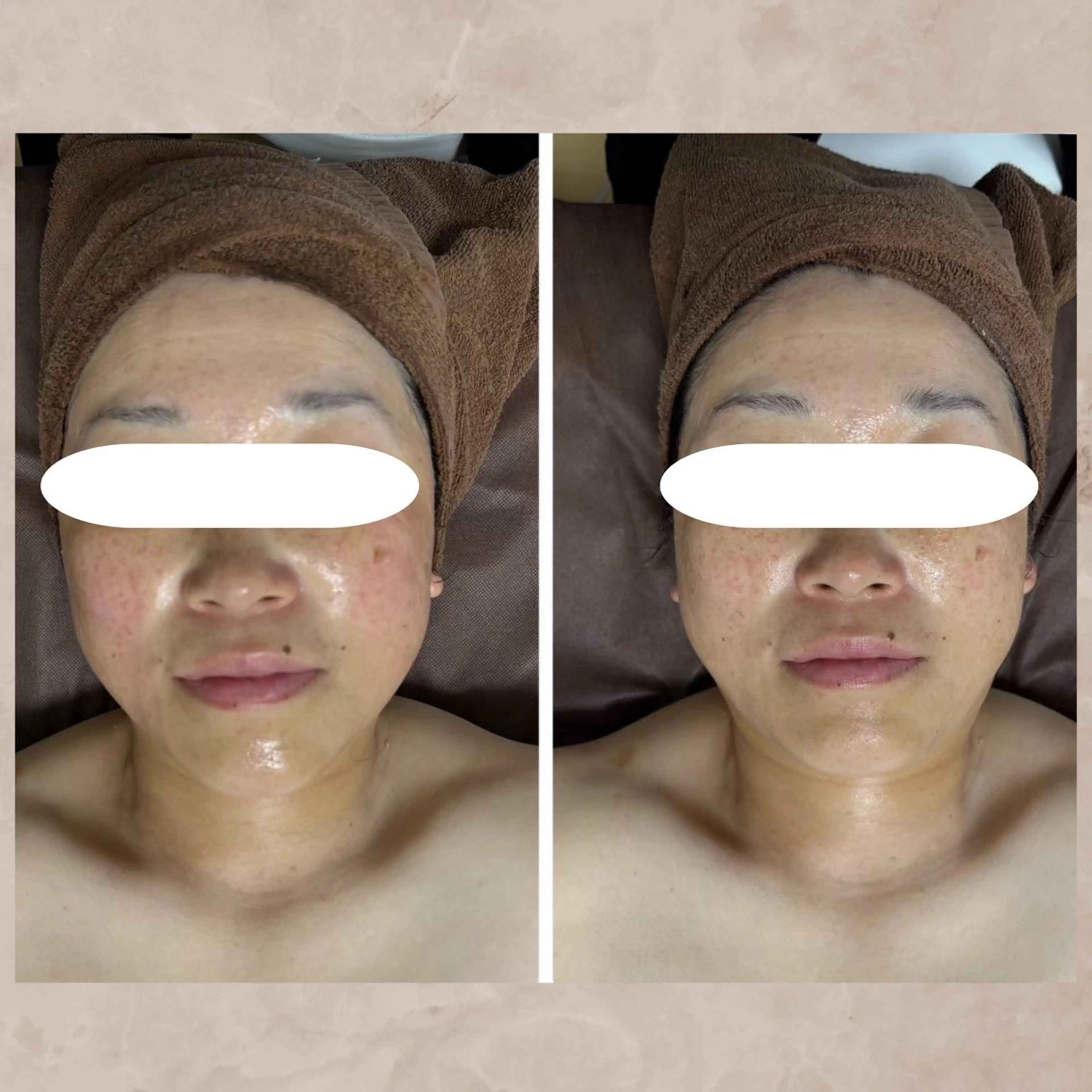 【平日限定‼️】肌カウンセリング付き◎小顔矯正フェイシャル💆‍♀️❤️の写真
