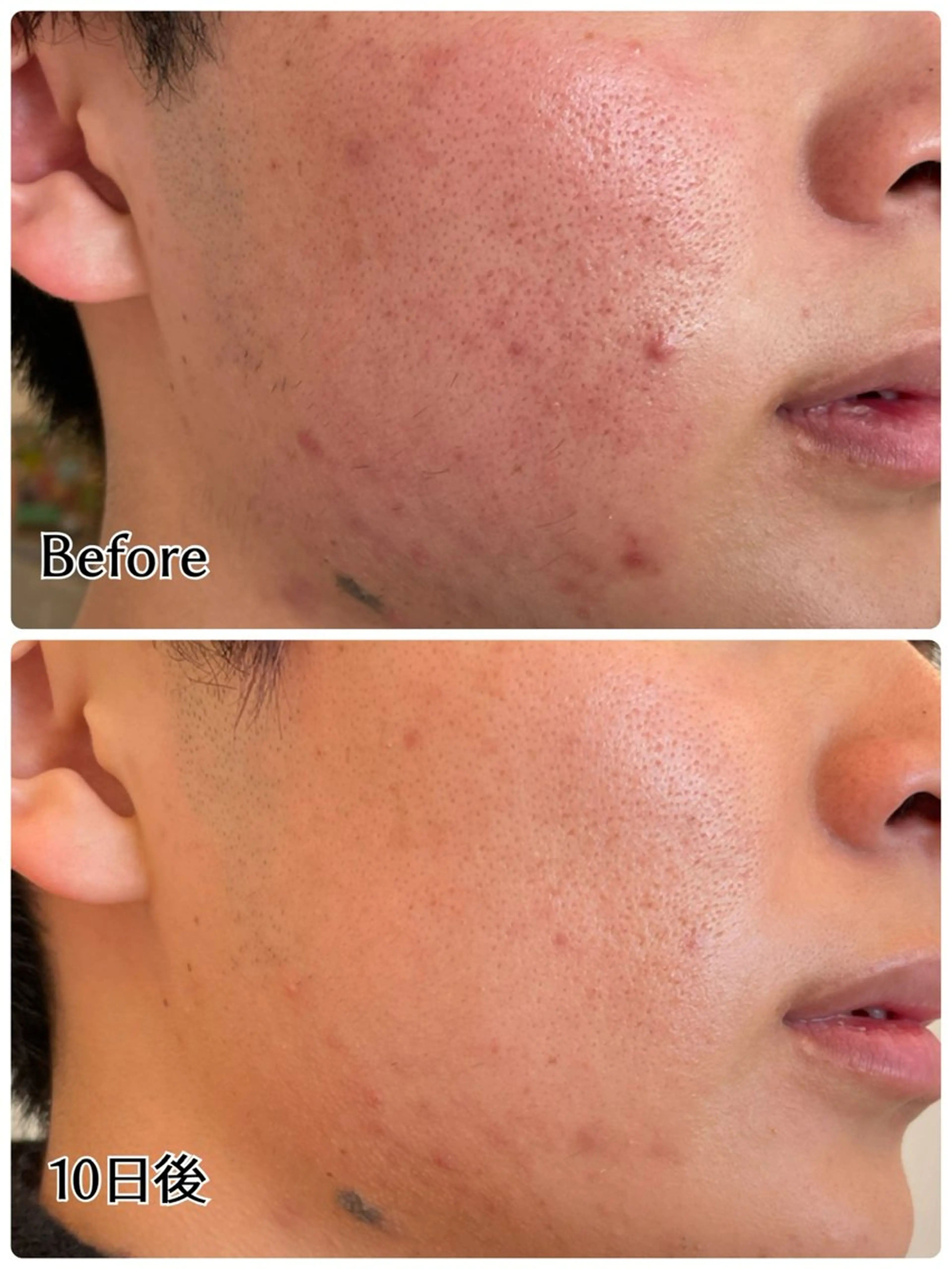【ニキビ肌💆‍♀️症例写真モニター募集🙏】ニキビが気になる方・痛くない・即メイクOK・漢方生ハーブピーリング🌿の写真