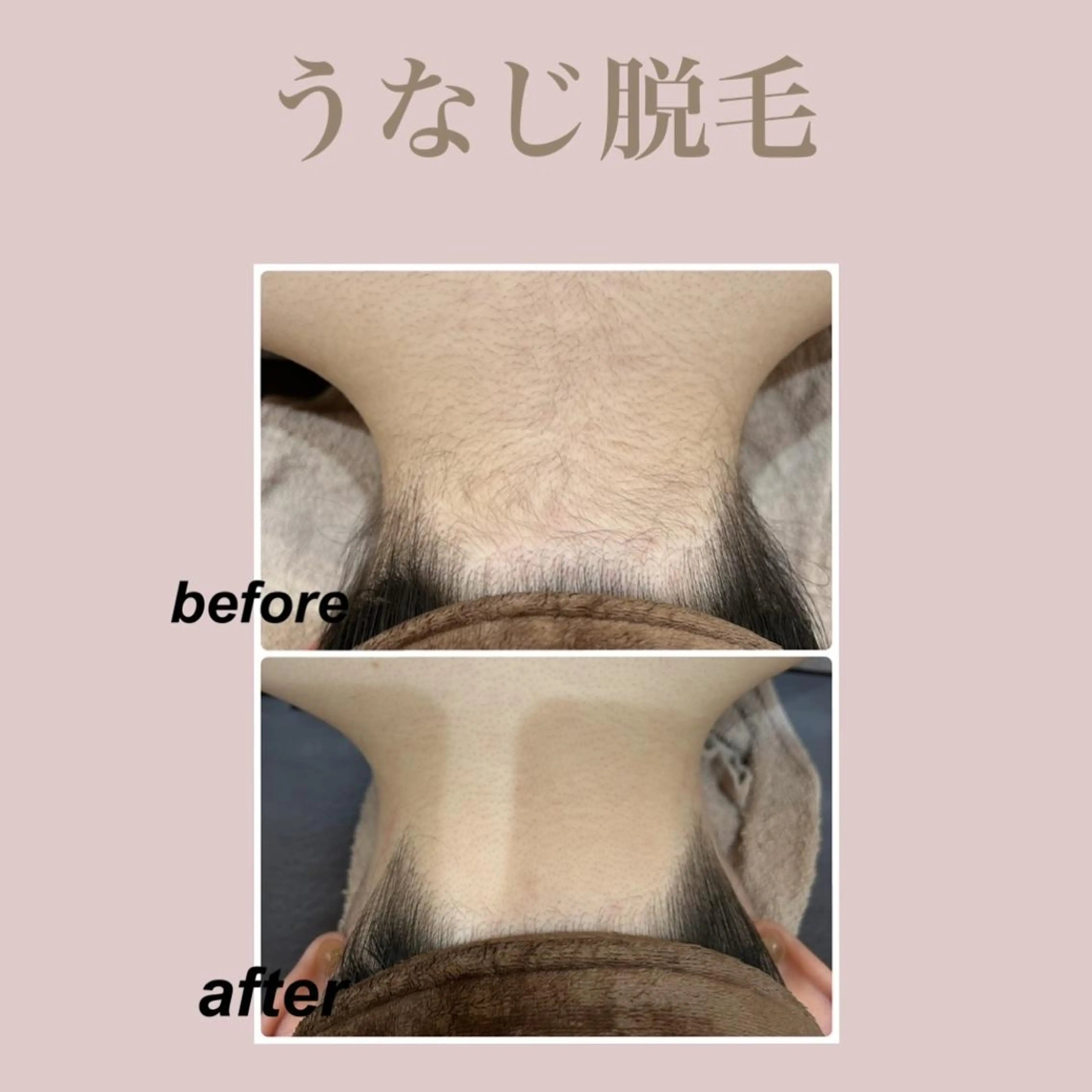平日限定脱毛が初めての方限定✨【うなじ脱毛】当店自慢のIPL方式で抜け落ち抜群⭕デザインシェービング付きだから安心🩵の写真