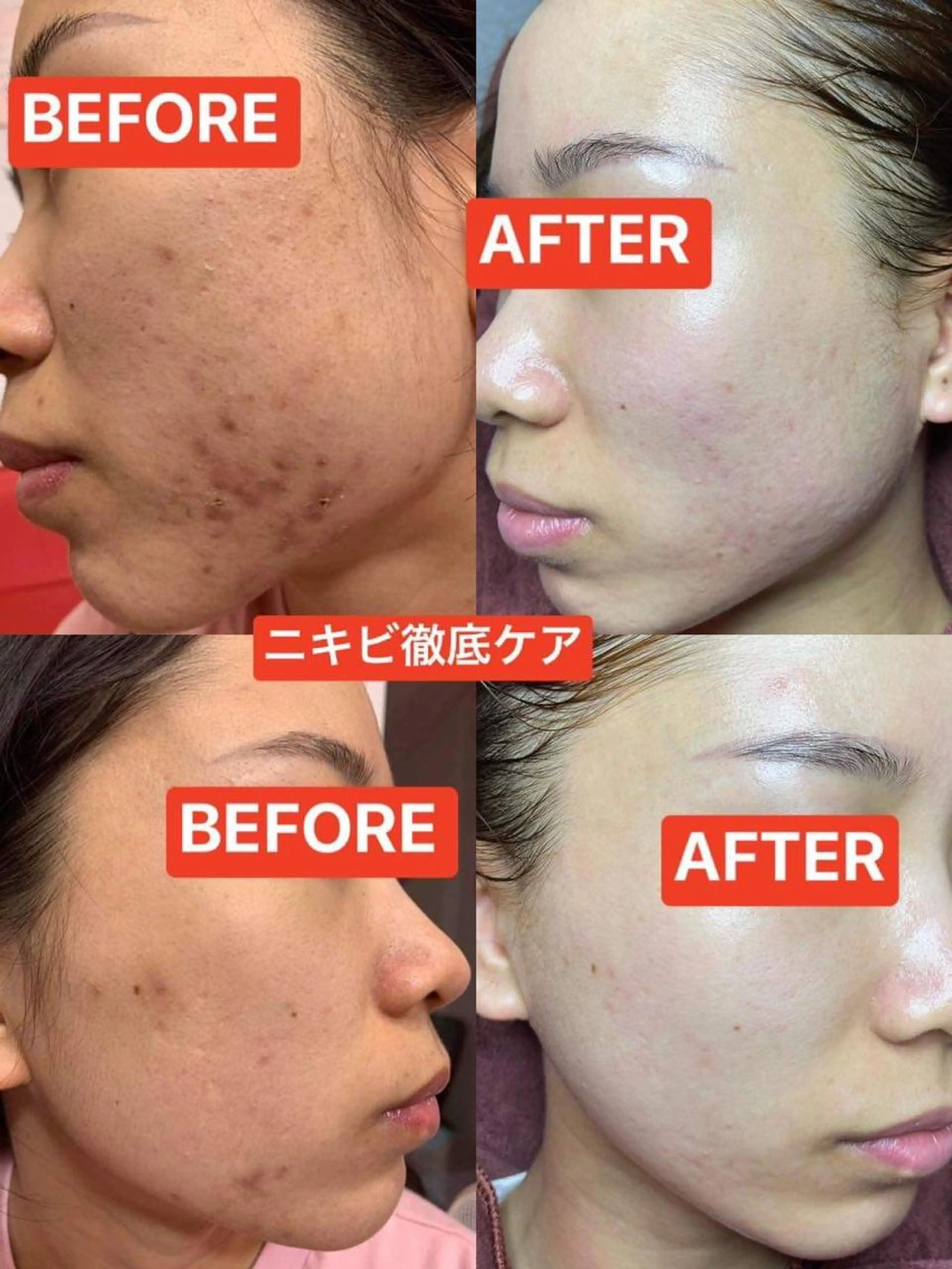 エステ ニキビ、痩身、脱毛、 サクラチャンスパのエステ・リラクイメージ