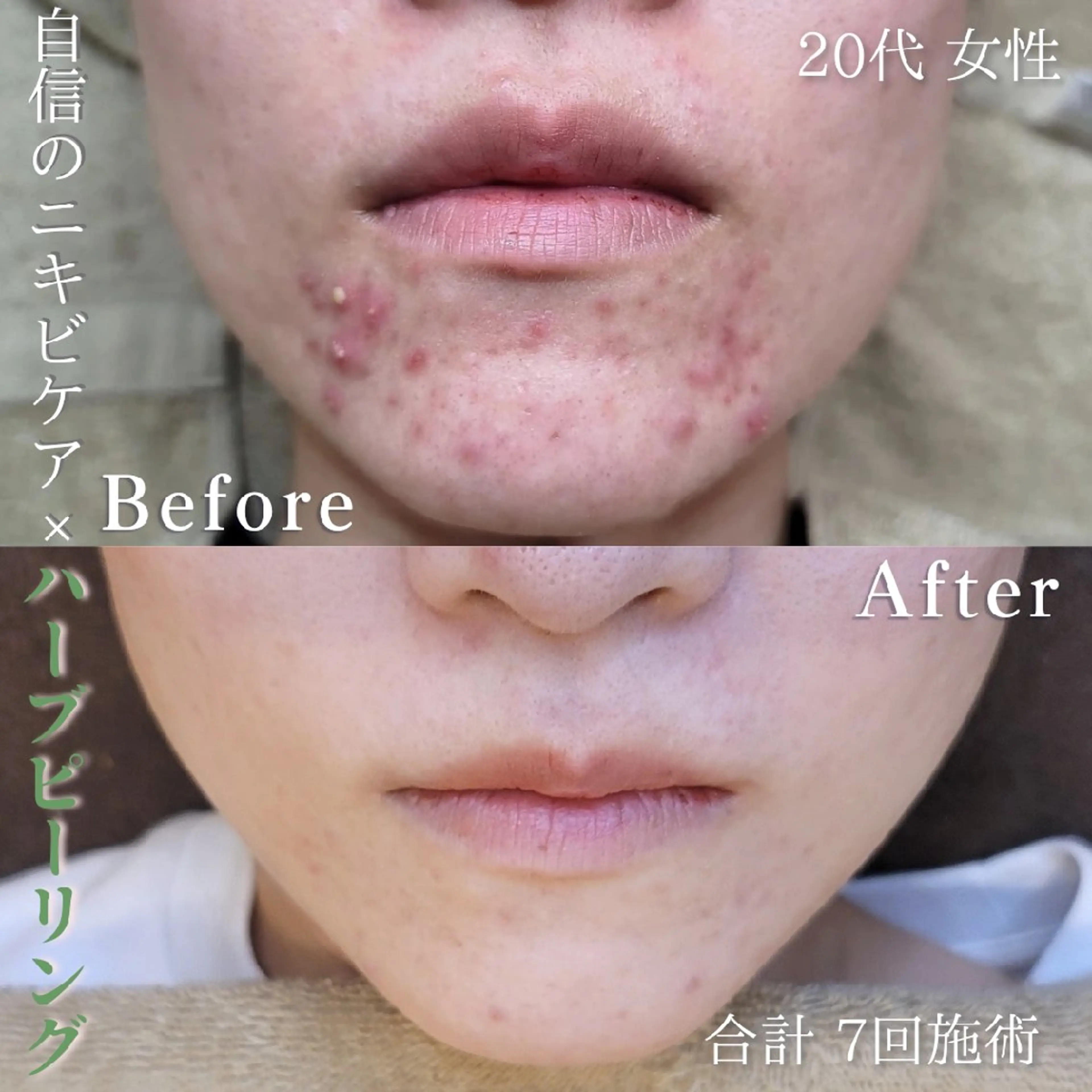 era: kayla 毛穴・ニキビ改善のエステ・リラクイメージ