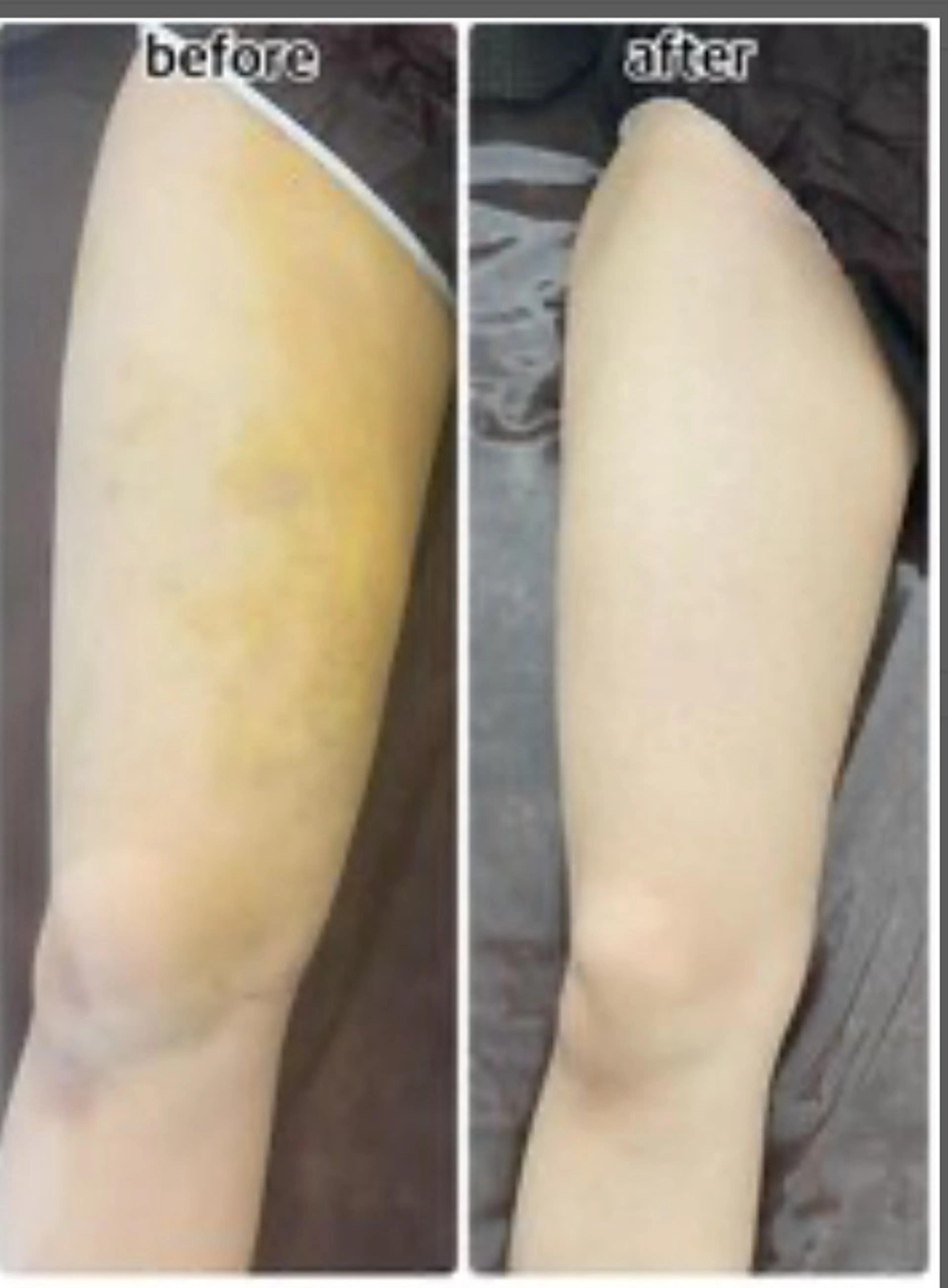 🌸🌸 【術後ケア】インディバ90分 上半身/下半身★浮腫み・腫れ¥11,000の写真