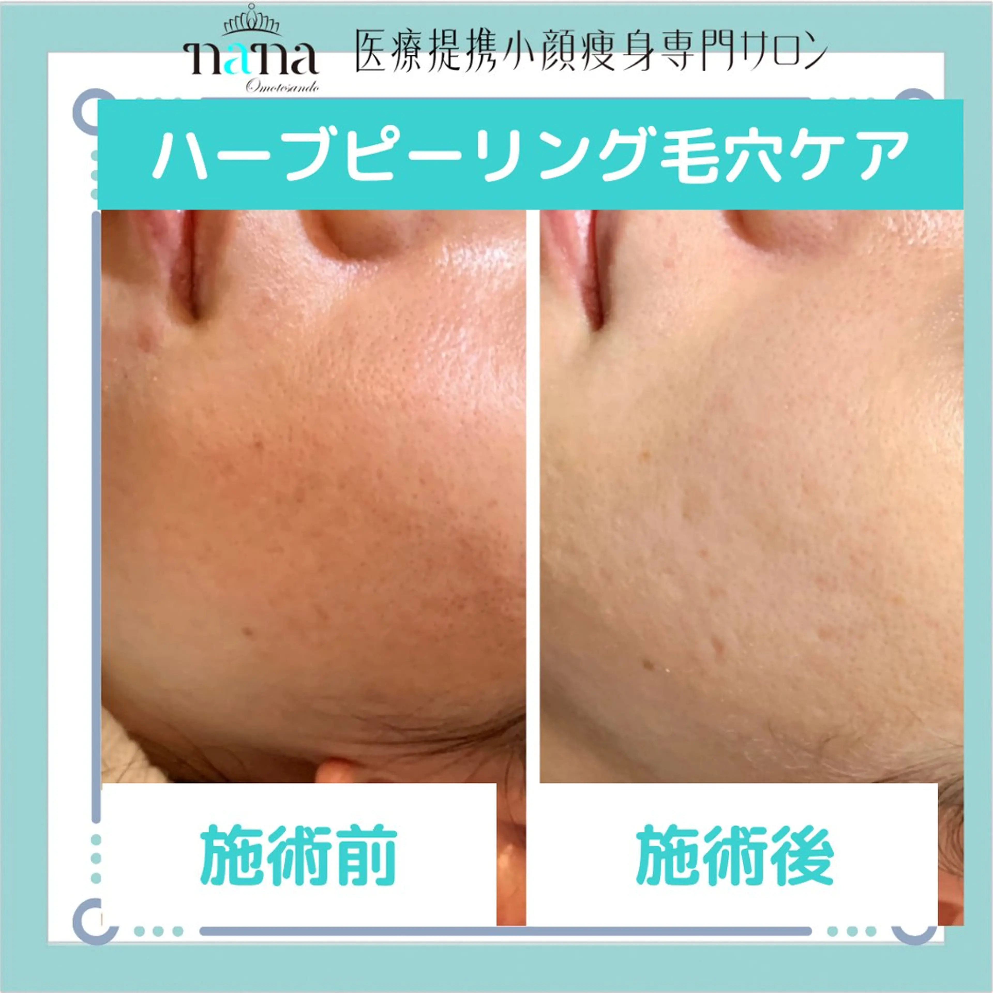 メンズ 小顔痩身インディバ Nana表参道のエステ・リラクイメージ