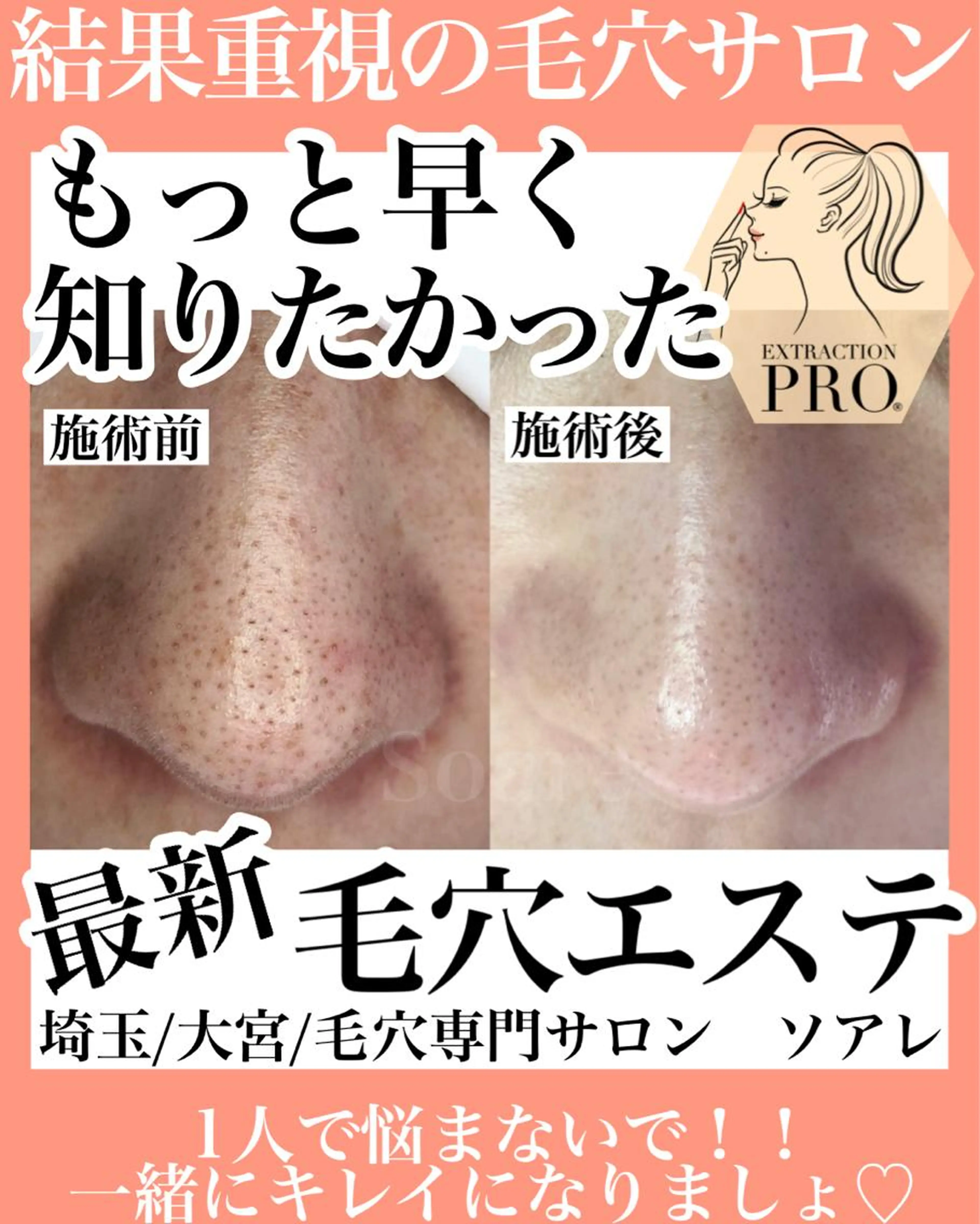 今話題！最新毛穴エステ　毛穴エクストラクションプロの写真
