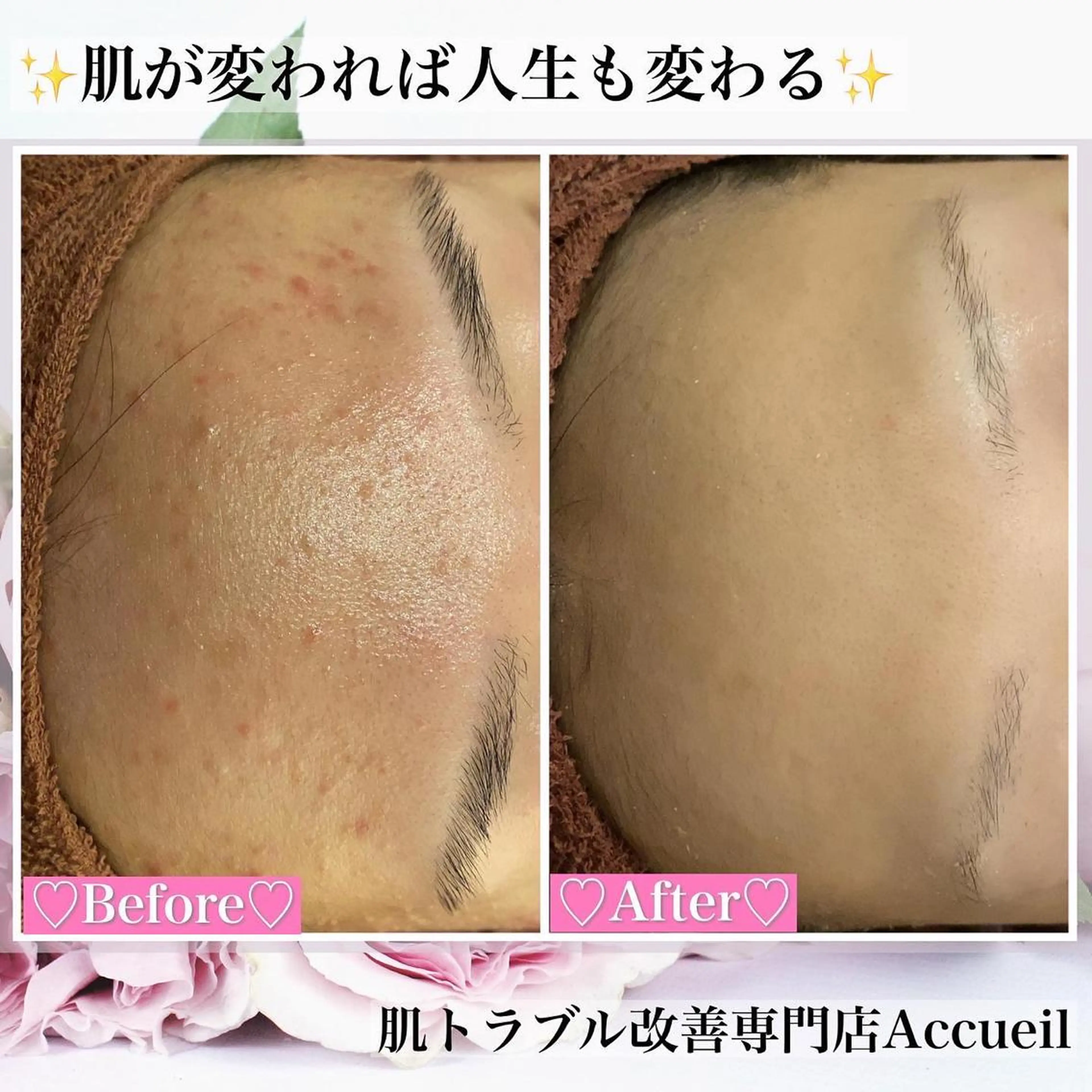 ミディアム カラー パーマ ヘアアレンジ メンズ キッズ ネイル マツエク・マツパ アイブロウ エステ リラク アクール　齋藤 ♡肌トラブル卒業のエステ・リラクイメージ