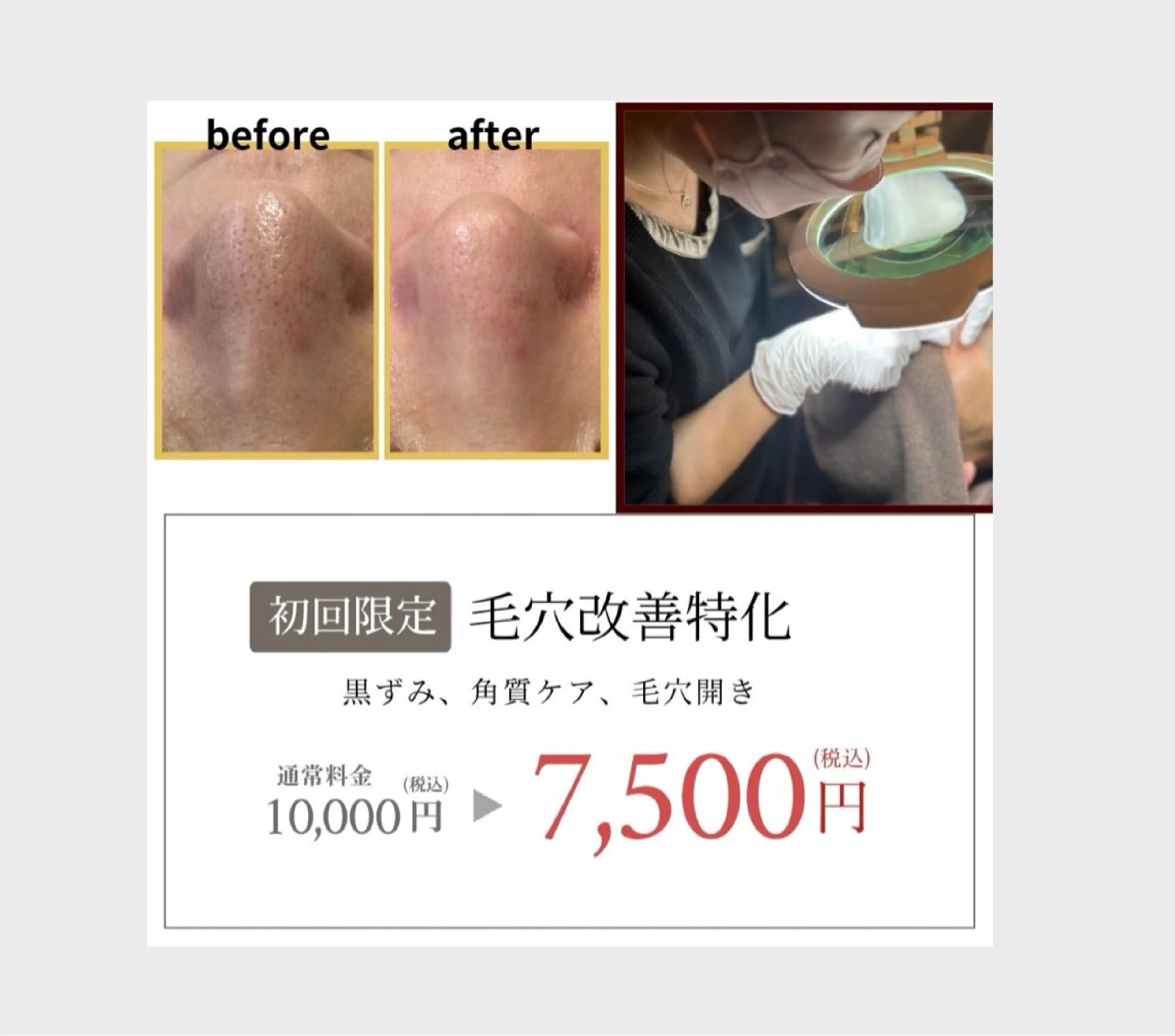 《毛穴の黒ずみ/皮脂汚れ/開き毛穴》最新毛穴ケア+光フェイシャル  60分の写真