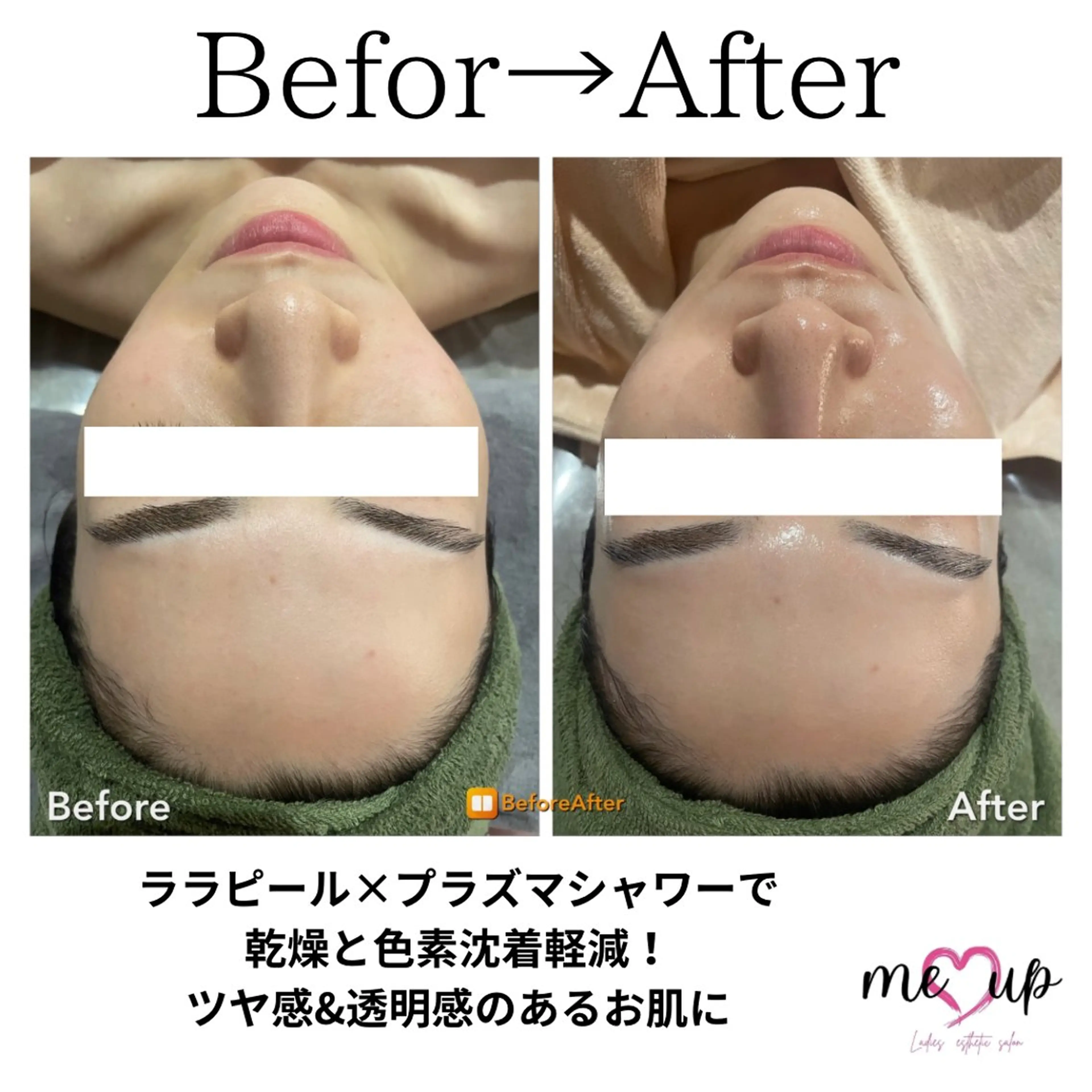 エステ Meupニキビ専門店 背中/ハーブ/ララのその他イメージ