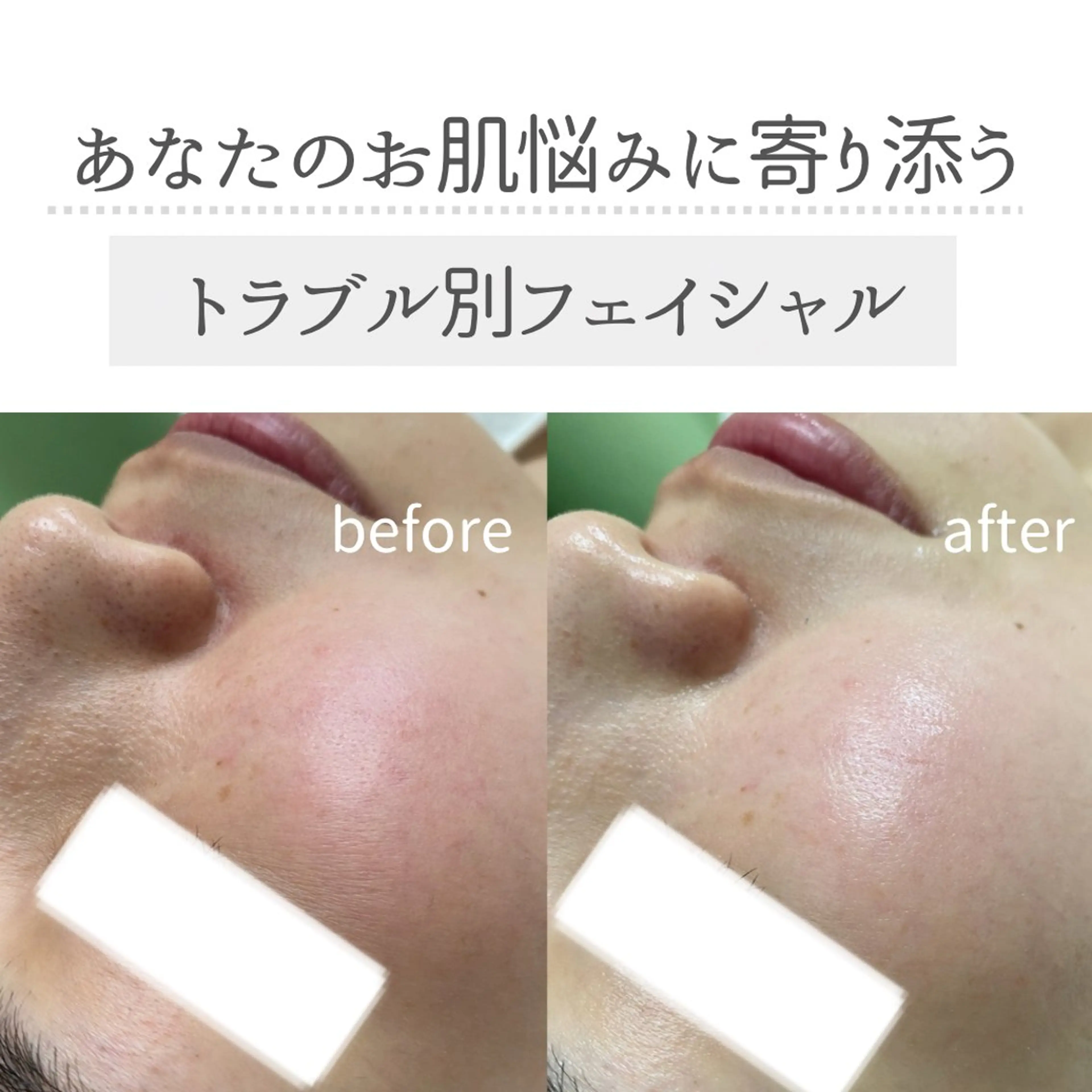 minimo初回限定【トラブル別フェイシャル🕊️】の写真
