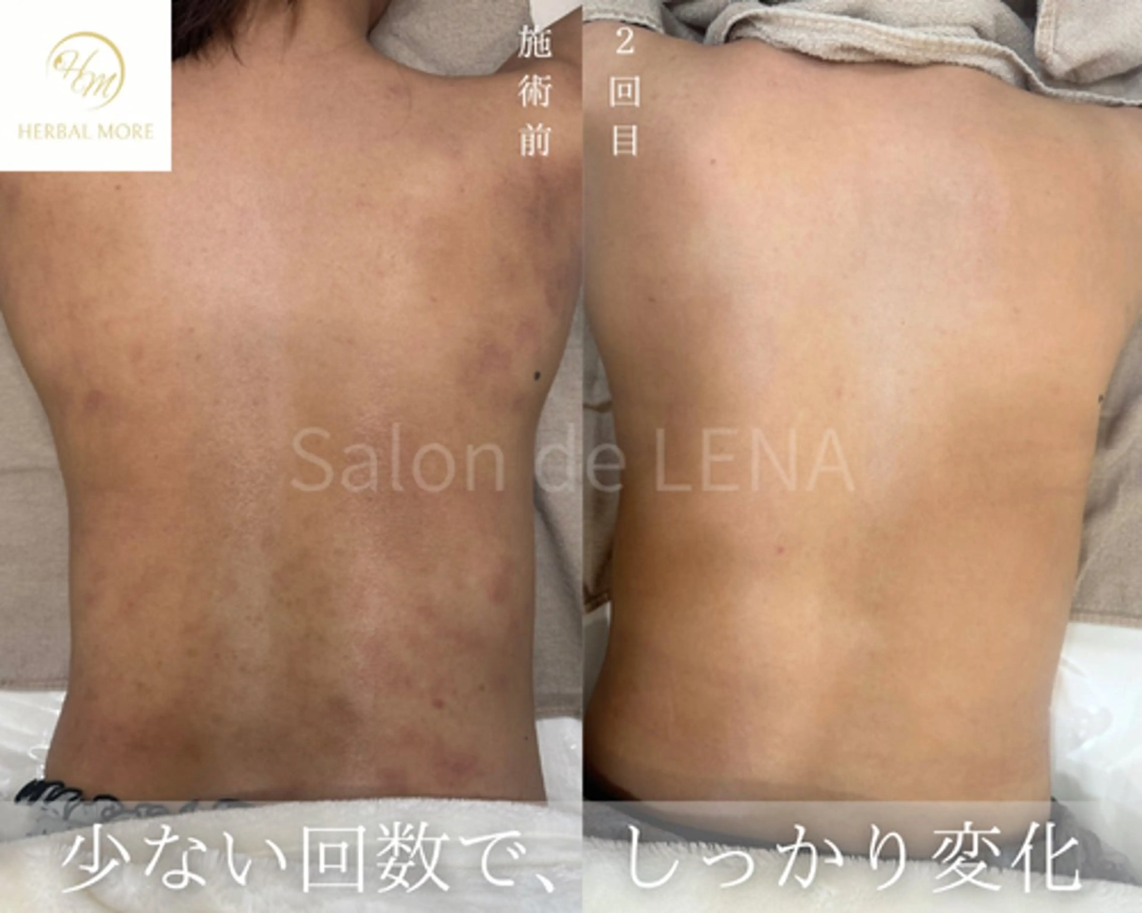 【背中◆35歳​〜​59歳限定】剥離ありハーブピーリングの写真