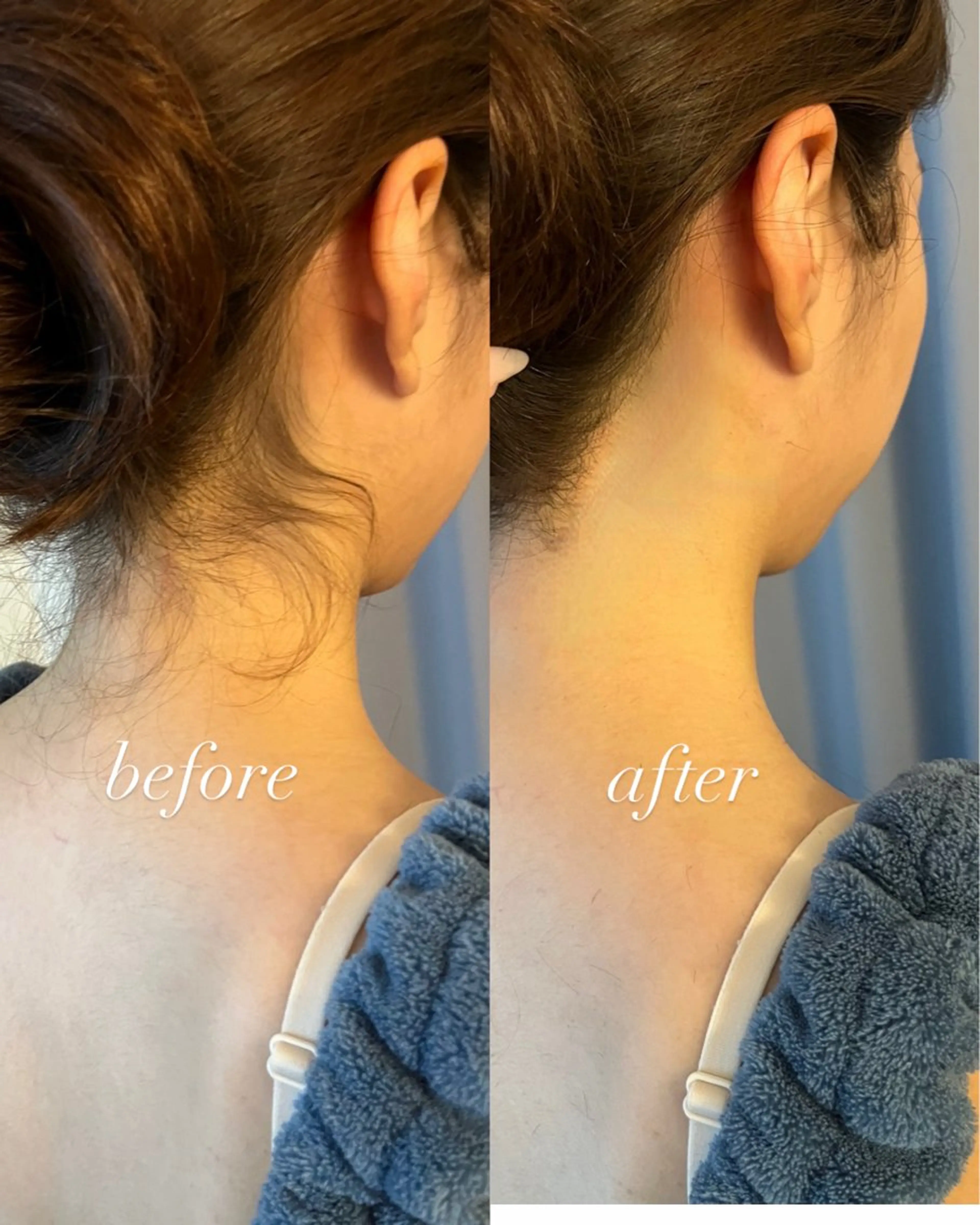 脱毛 うなじ脱毛/美肌脱毛 LABELのエステ・リラクイメージ