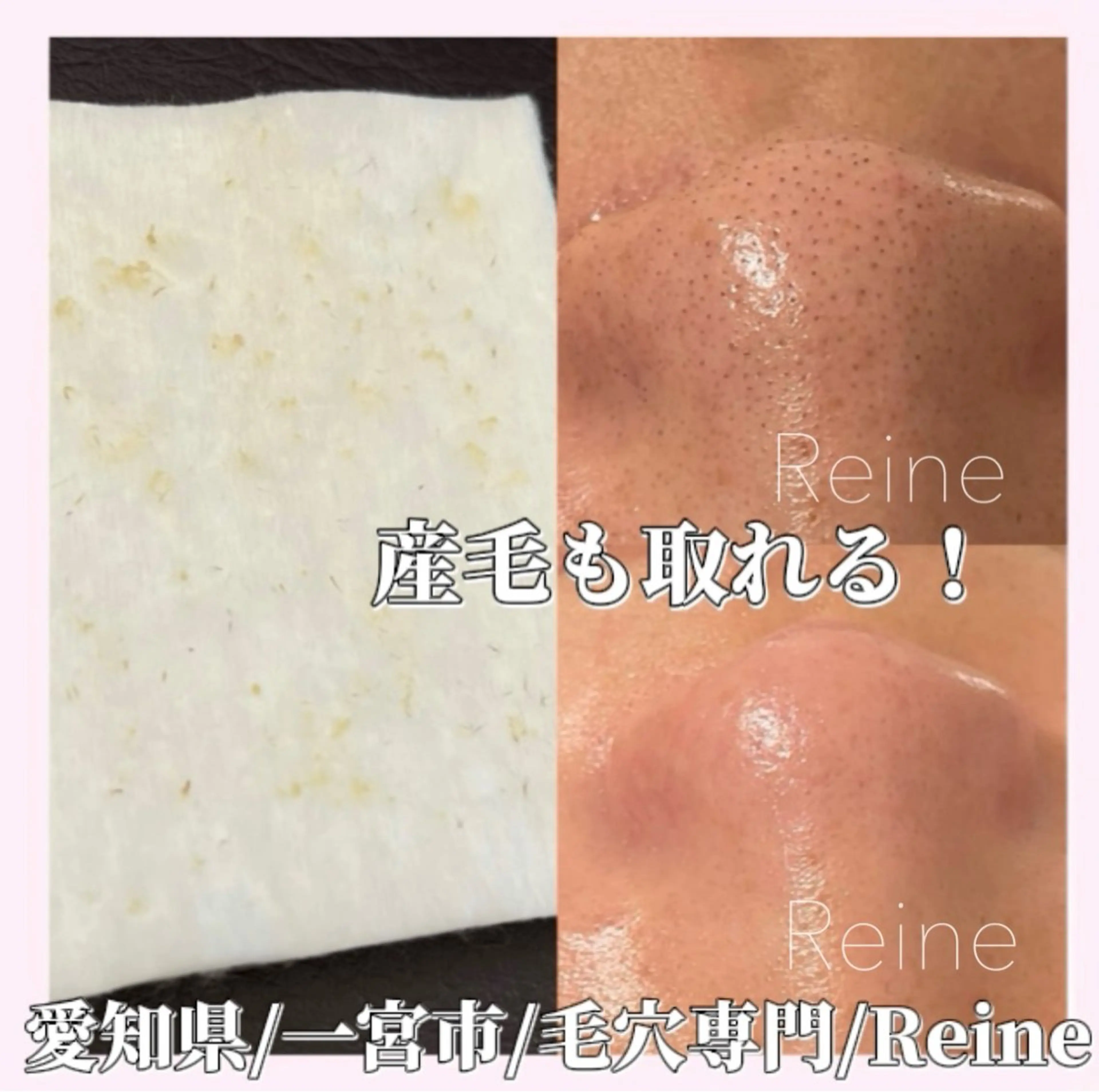 エステ Reine BeautySalon所属・毛穴/シミ肝斑/脱毛 横山梨里のエステ・リラクイメージ