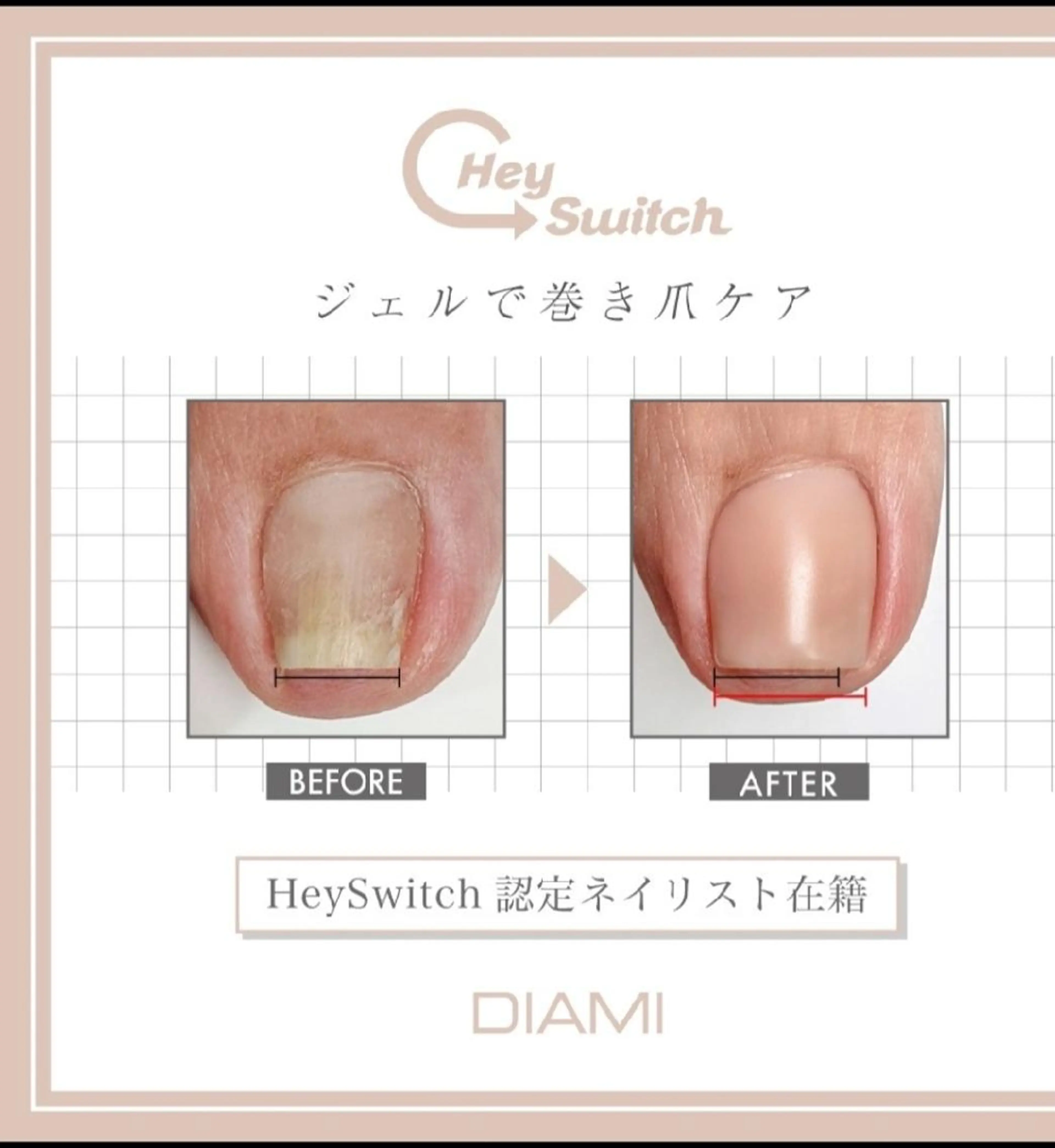 👣フット専用👣　巻き爪ケアの写真
