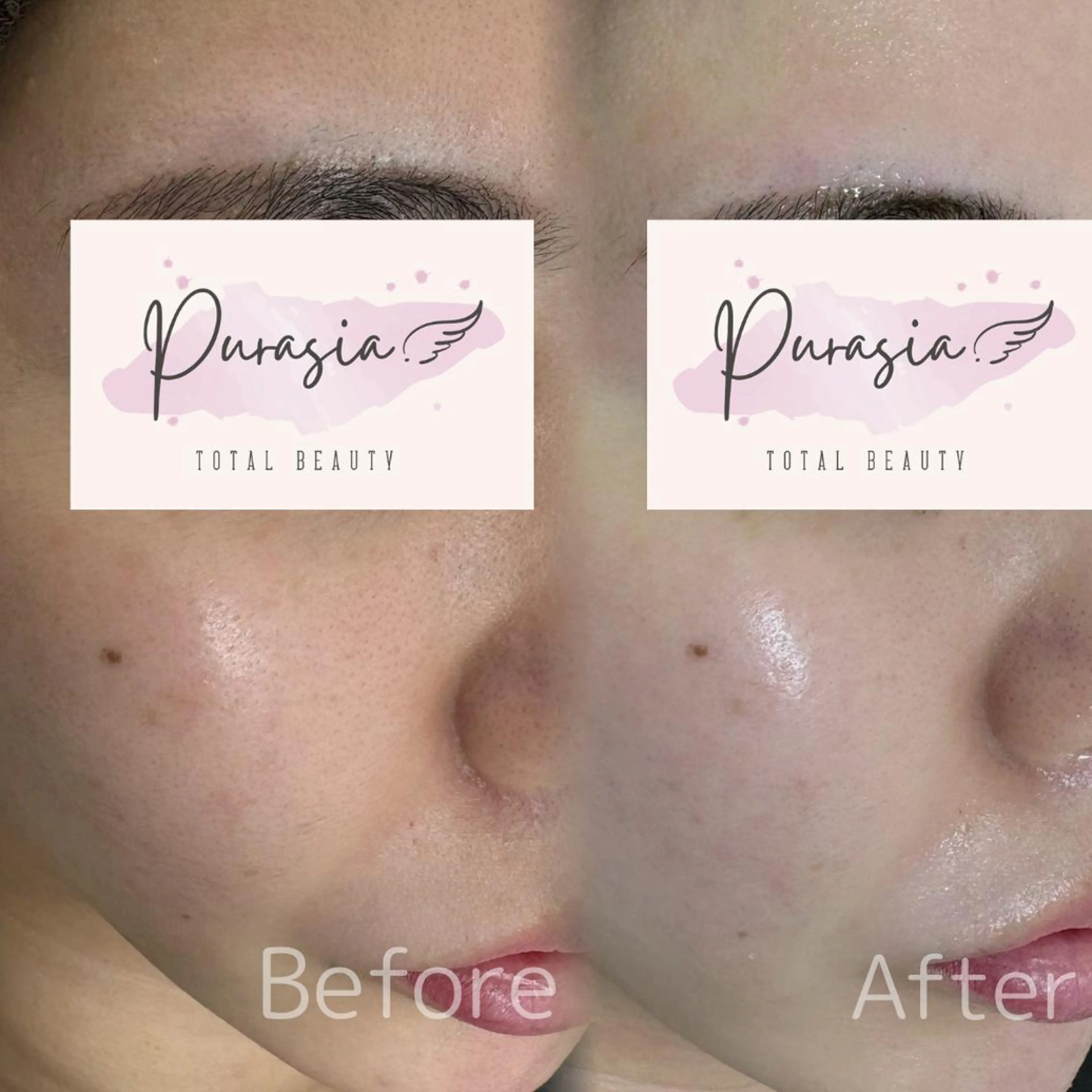 ⭐12月末まで35％OFF⭐水光ハーブピーリング×美肌LED照射×幹細胞マスク⭐ニキビや毛穴やくすみ改善⭐の写真