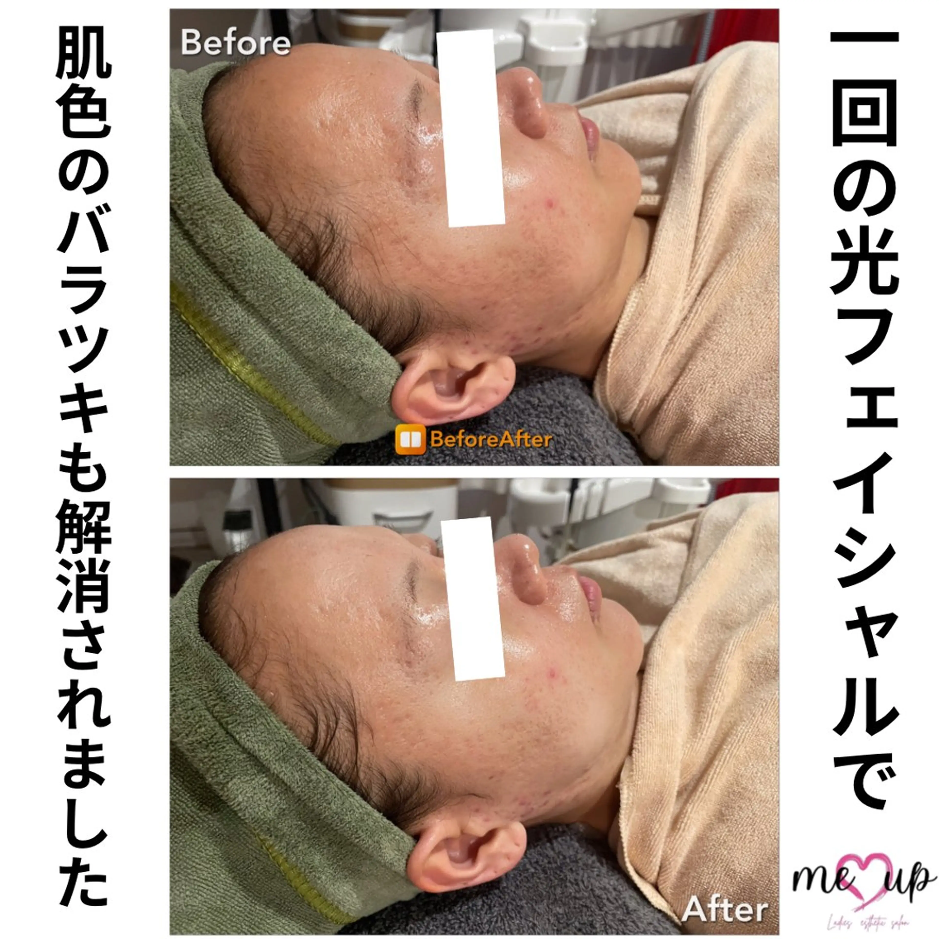 エステ Meupニキビ専門店 背中/ハーブ/ララのその他イメージ