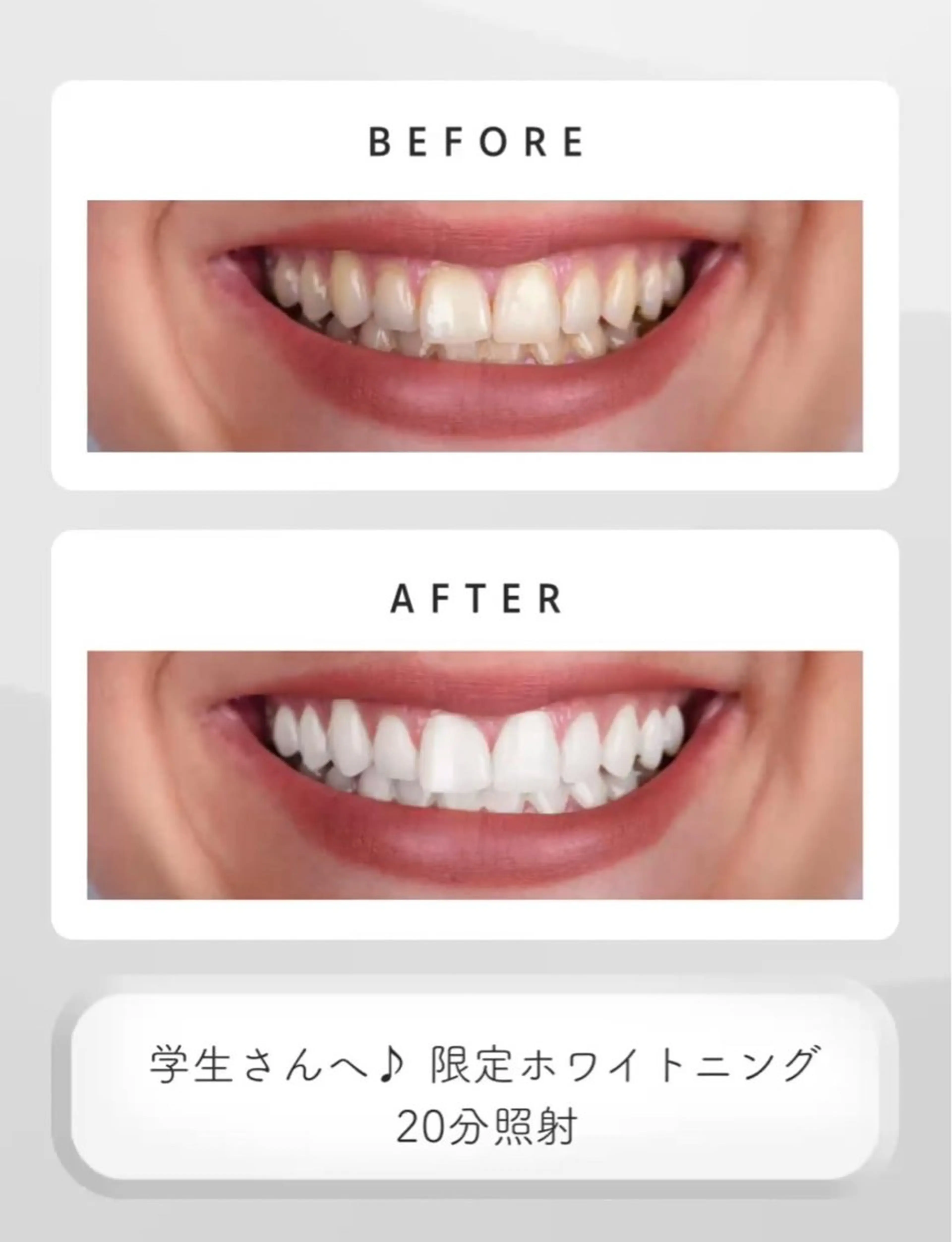 【学生さん必見！】ホワイトニングトリートメント付き🤍の写真