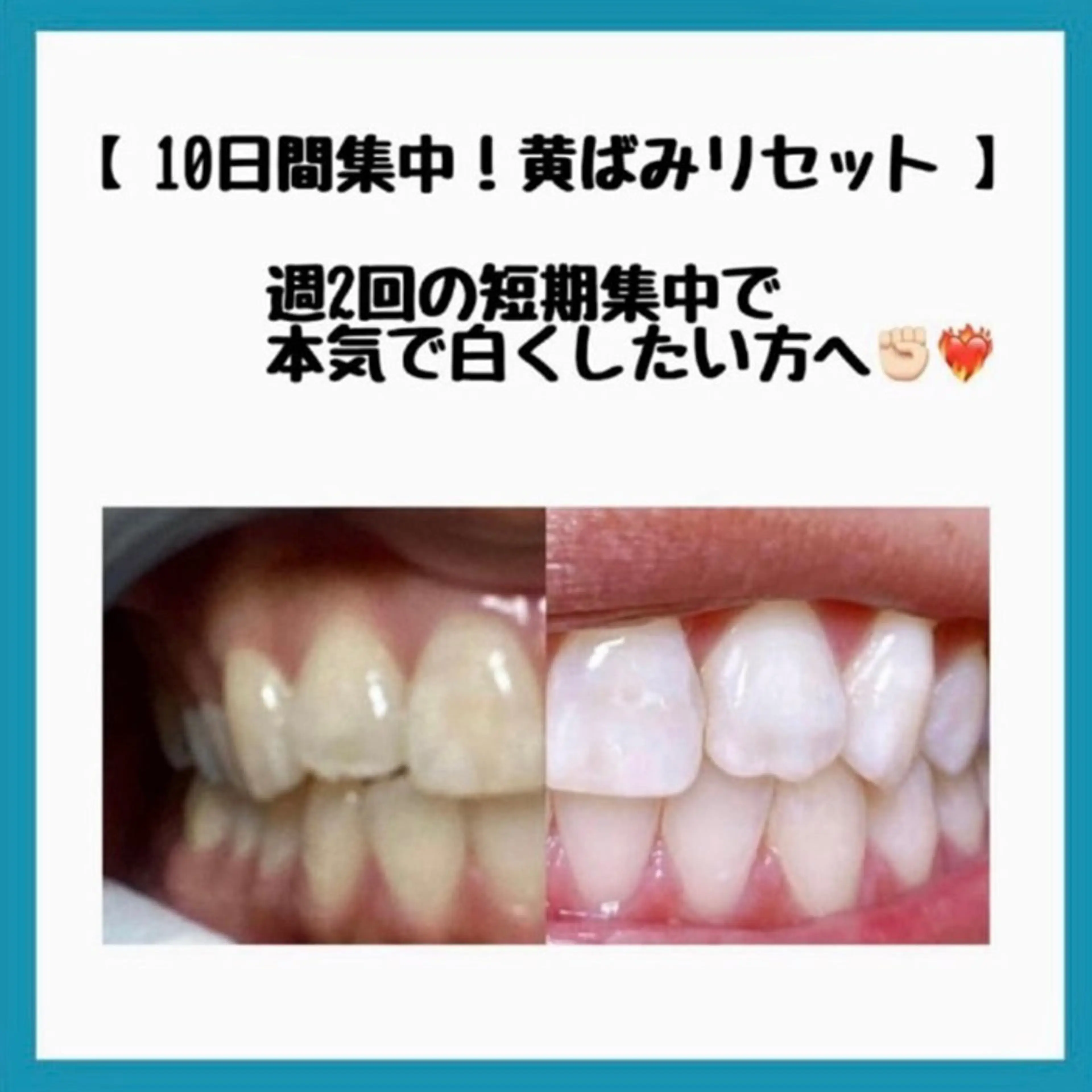 【4名限定🙇‍♀️年末前リセット🦷✨】新世代セルフホワイトニング(5回コース🪥15分×3回)の写真