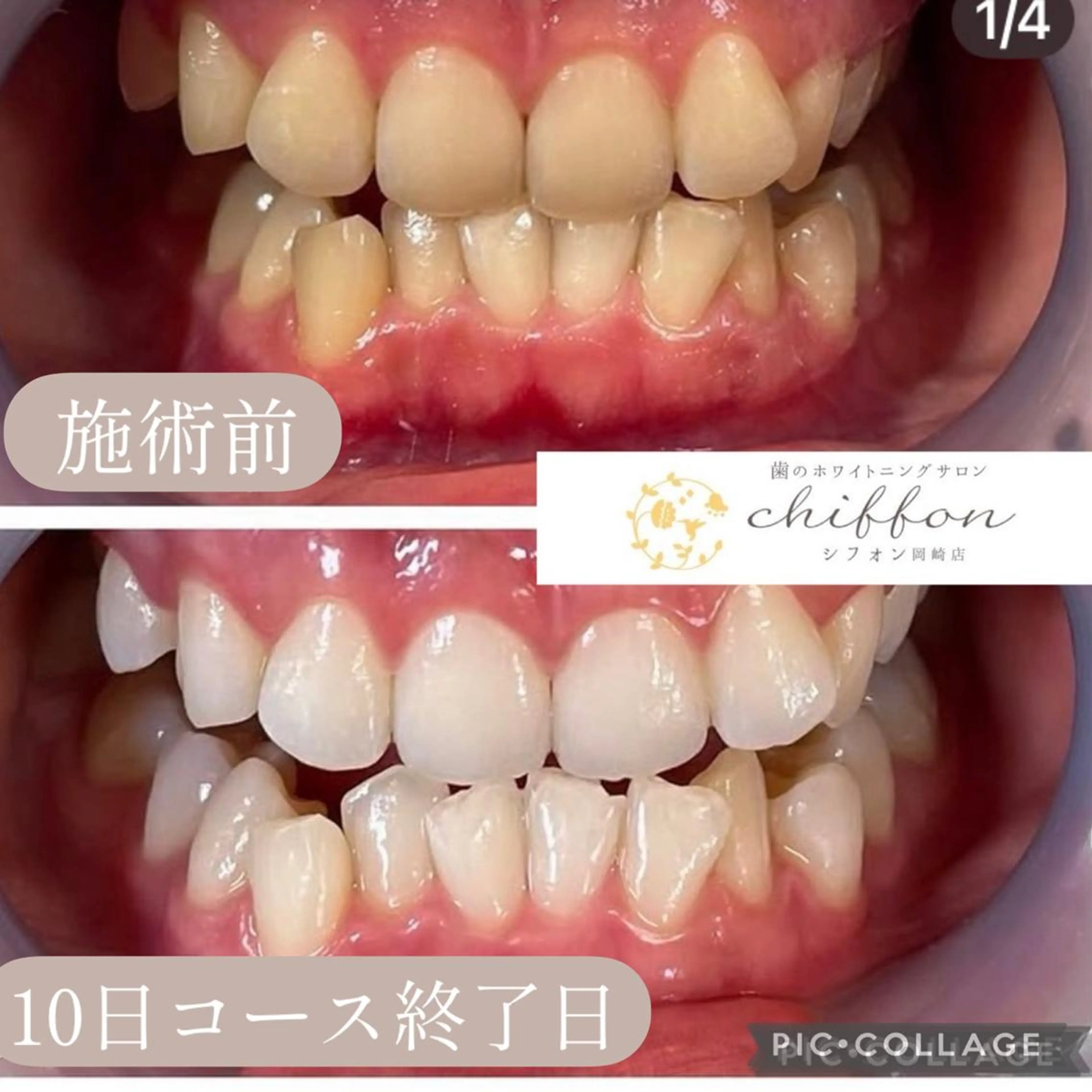 エステ 歯科レベルの白さ💎 ✨ホワイトニング岡崎のエステ・リラクイメージ