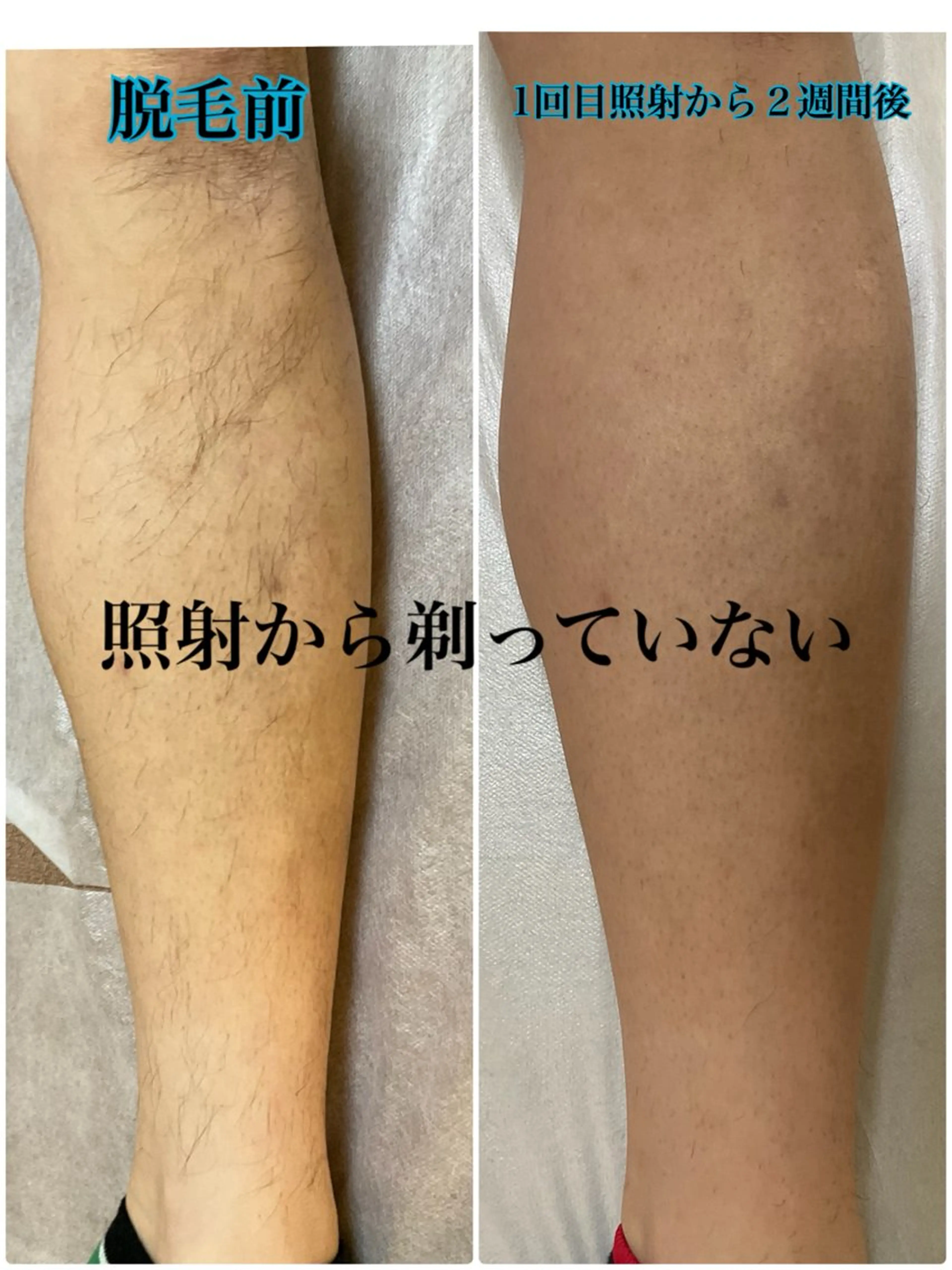 12月限定🎄【メンズ】光脱毛1箇所の写真