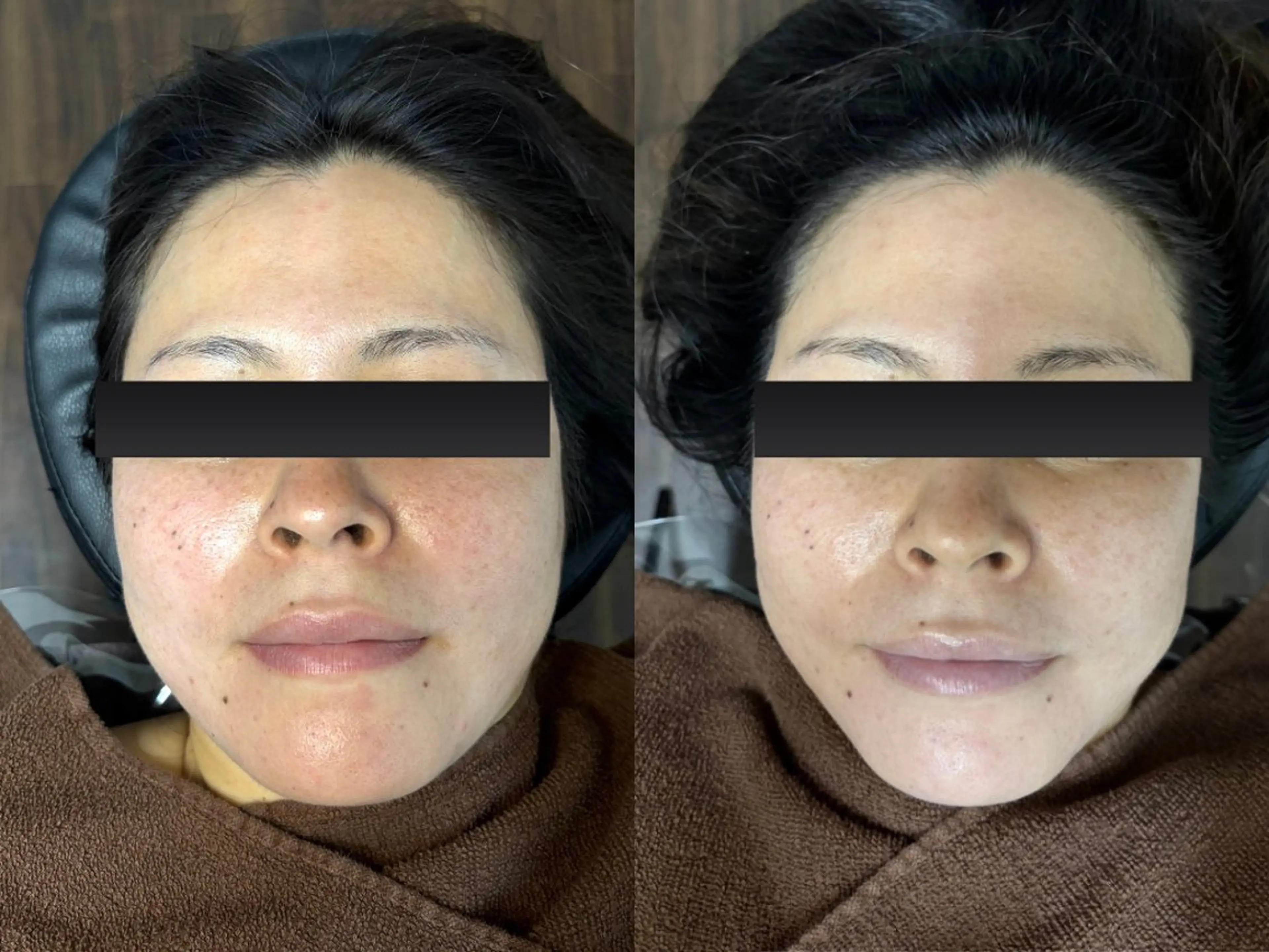 リアボーテ　マーメイドセルトリートメント（初回のみ）の写真