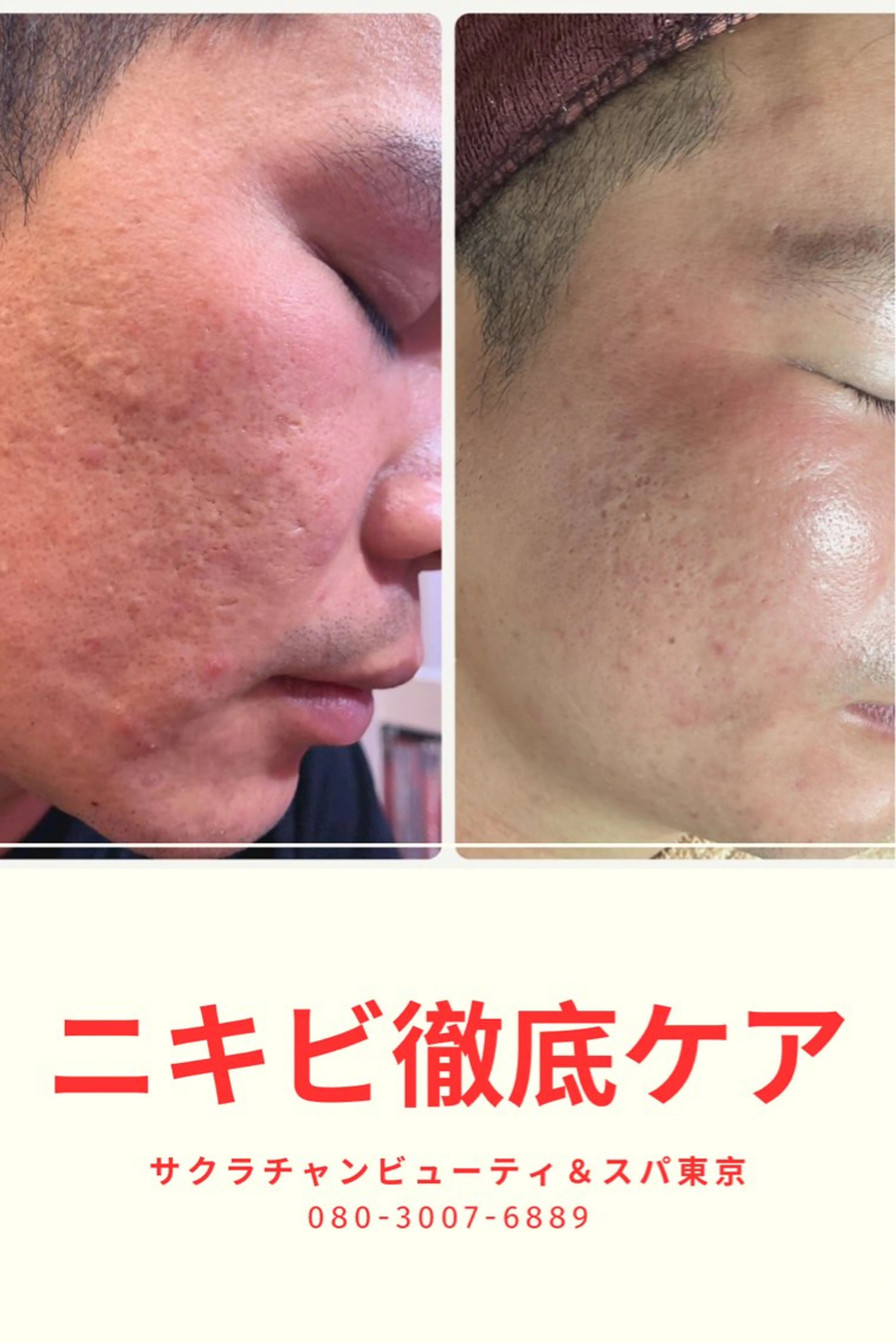 エステ ニキビ、痩身、脱毛、 サクラチャンスパのエステ・リラクイメージ