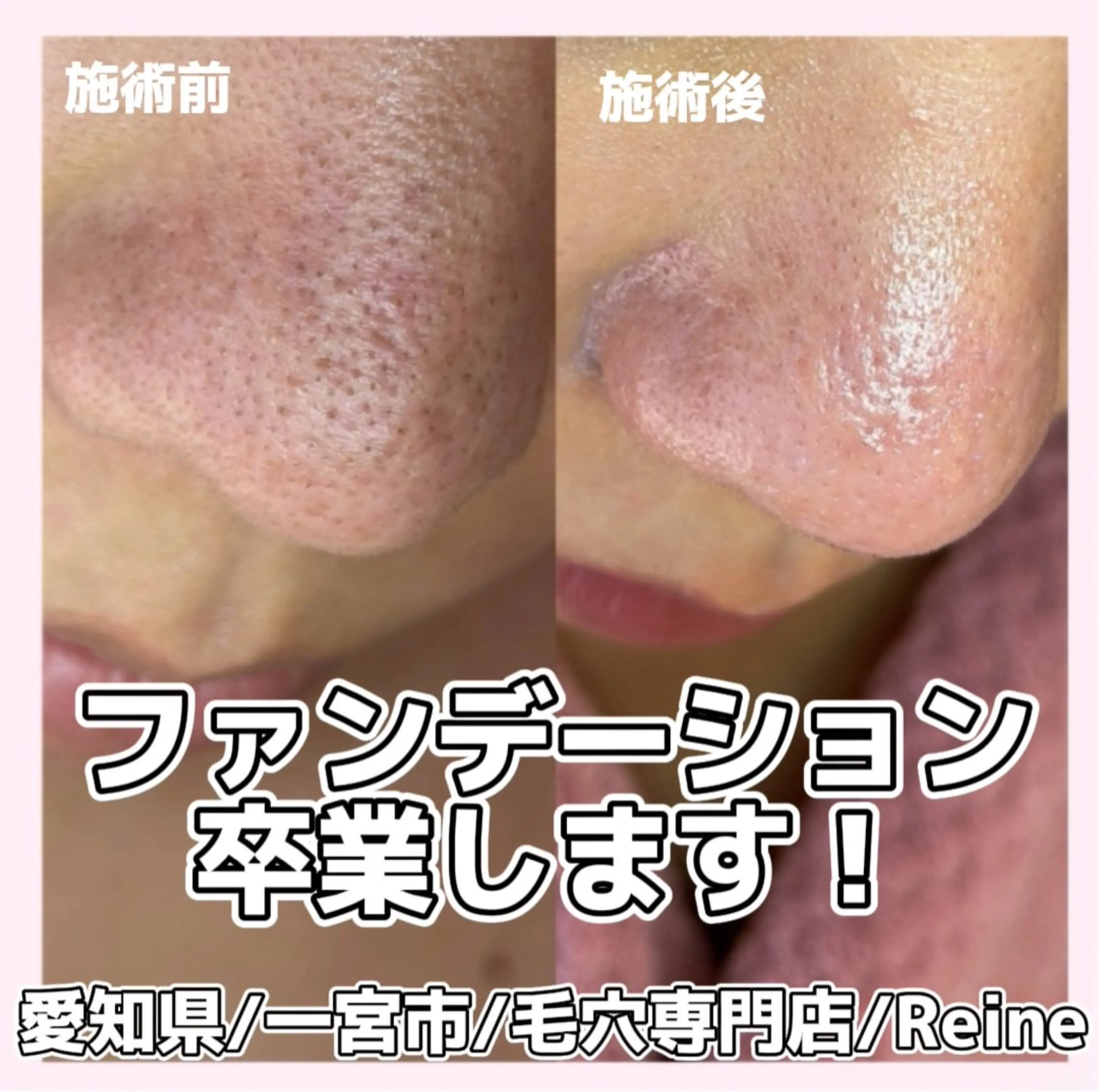 エステ Reine BeautySalon所属・毛穴/シミ肝斑/脱毛 横山梨里のエステ・リラクイメージ