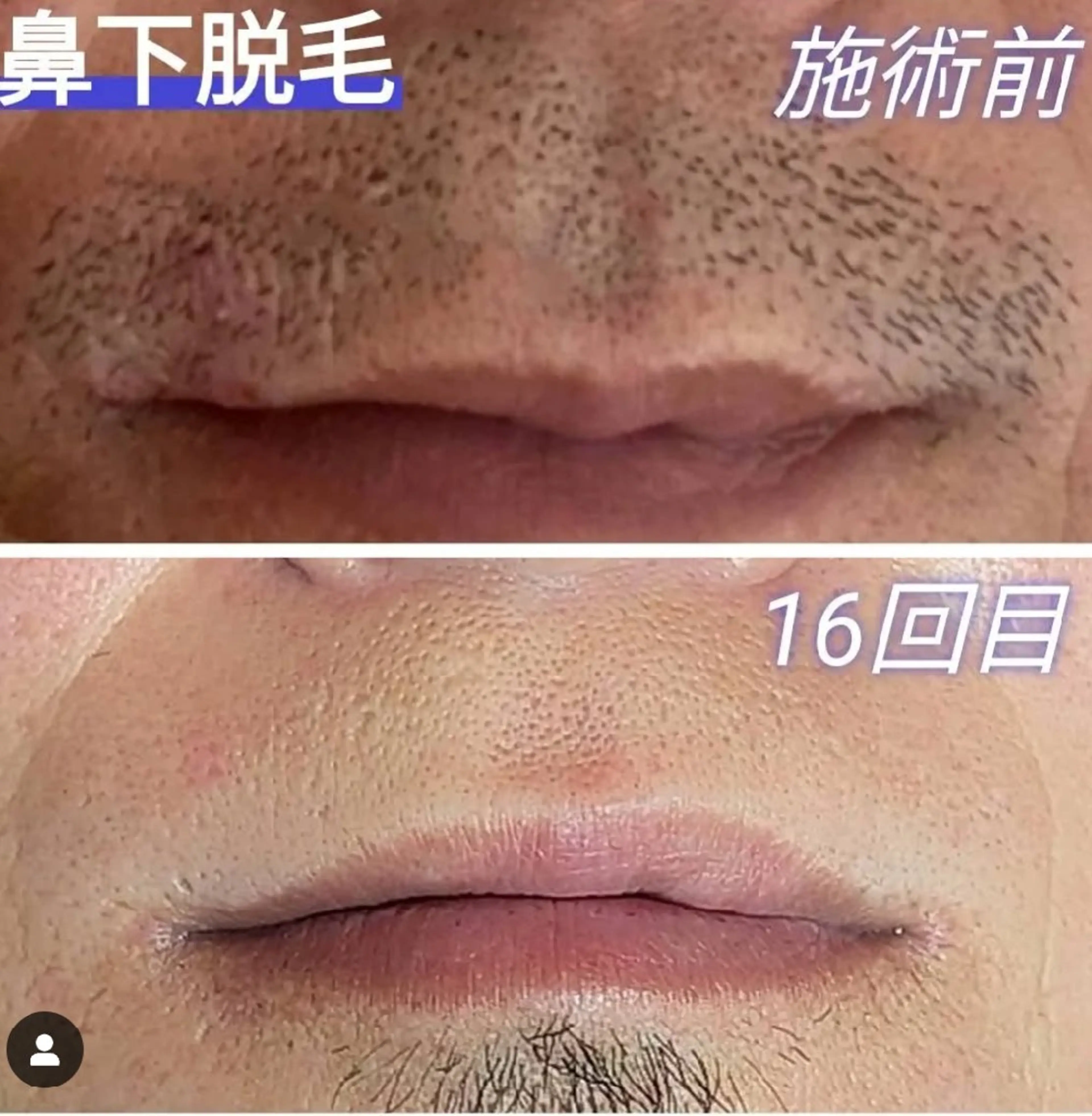 お試し髭脱毛(鼻下、あご、首、もみあげ、頬、)全ての写真