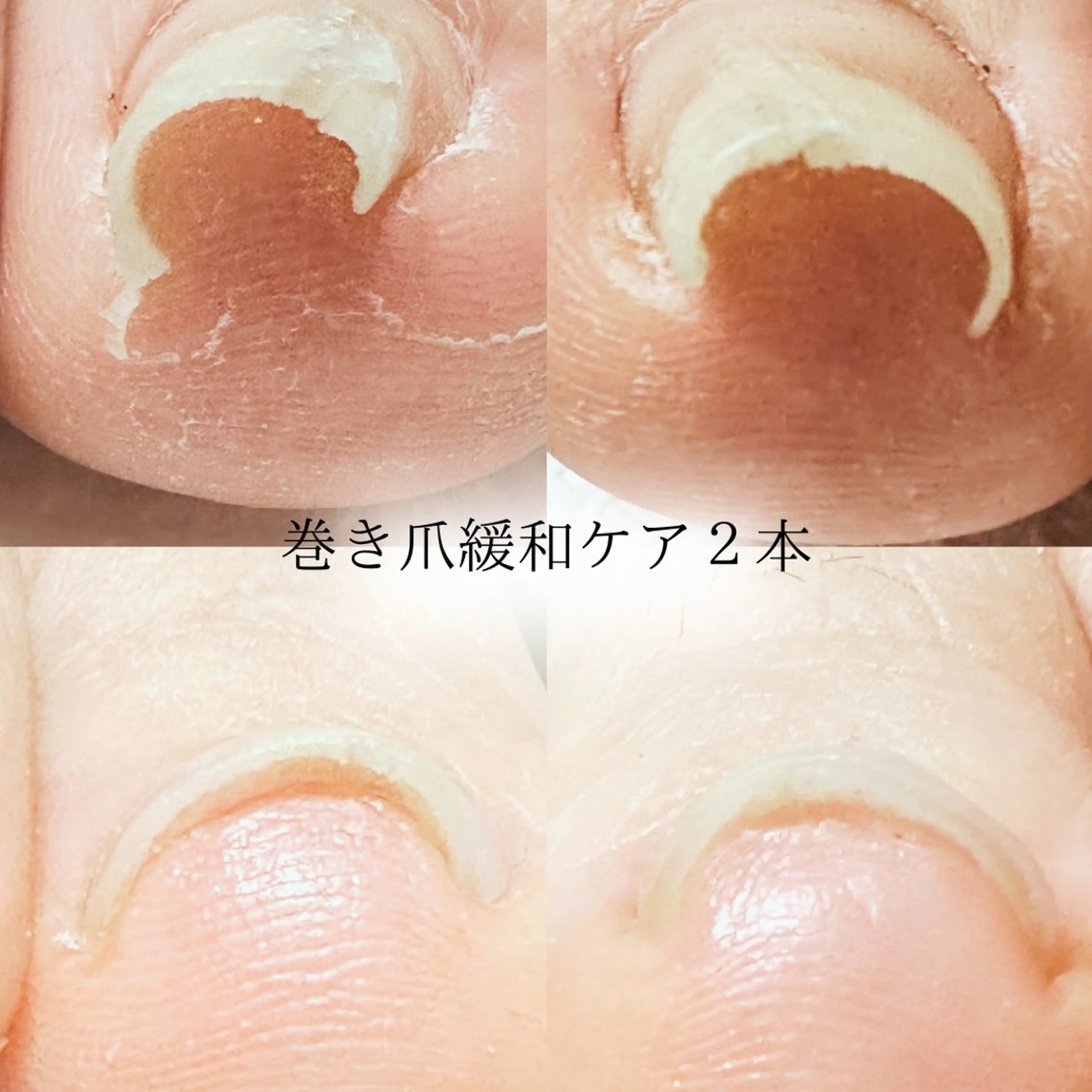 巻き爪緩和ケア＜2本＞🎁ご新規様ホームケアセットプレゼント🎁の写真