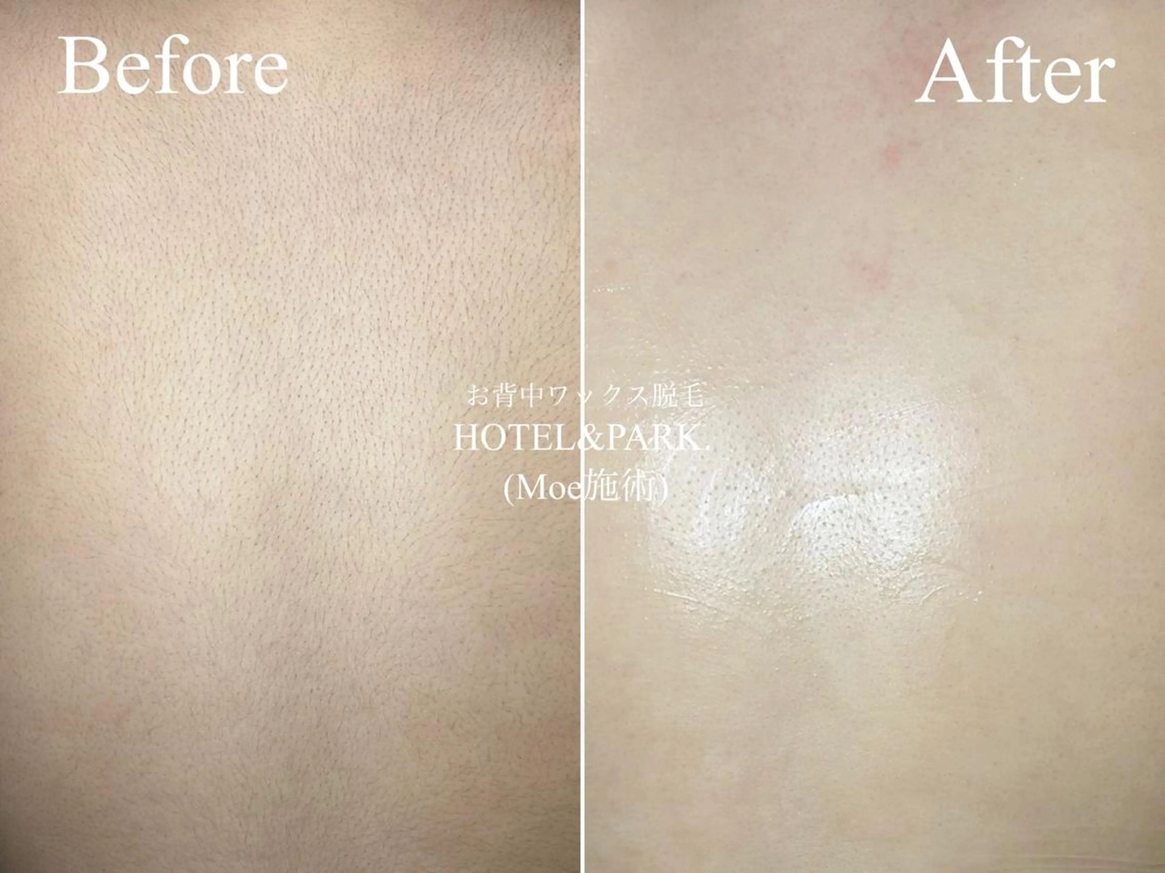 HOTEL&PARK . ワックス脱毛のエステ・リラクイメージ