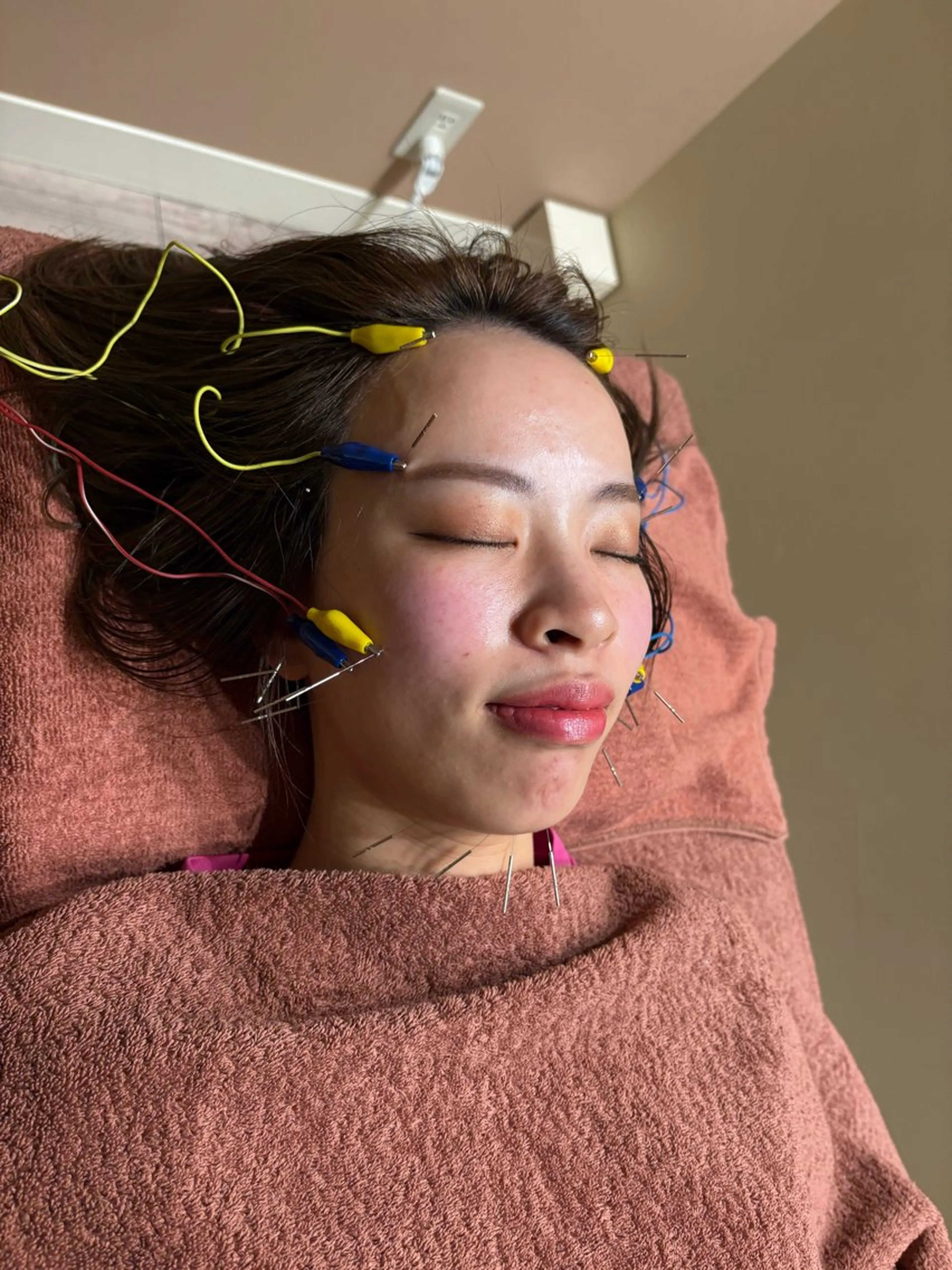 【モニター募集】美容鍼によるフェイケア⛄️の写真