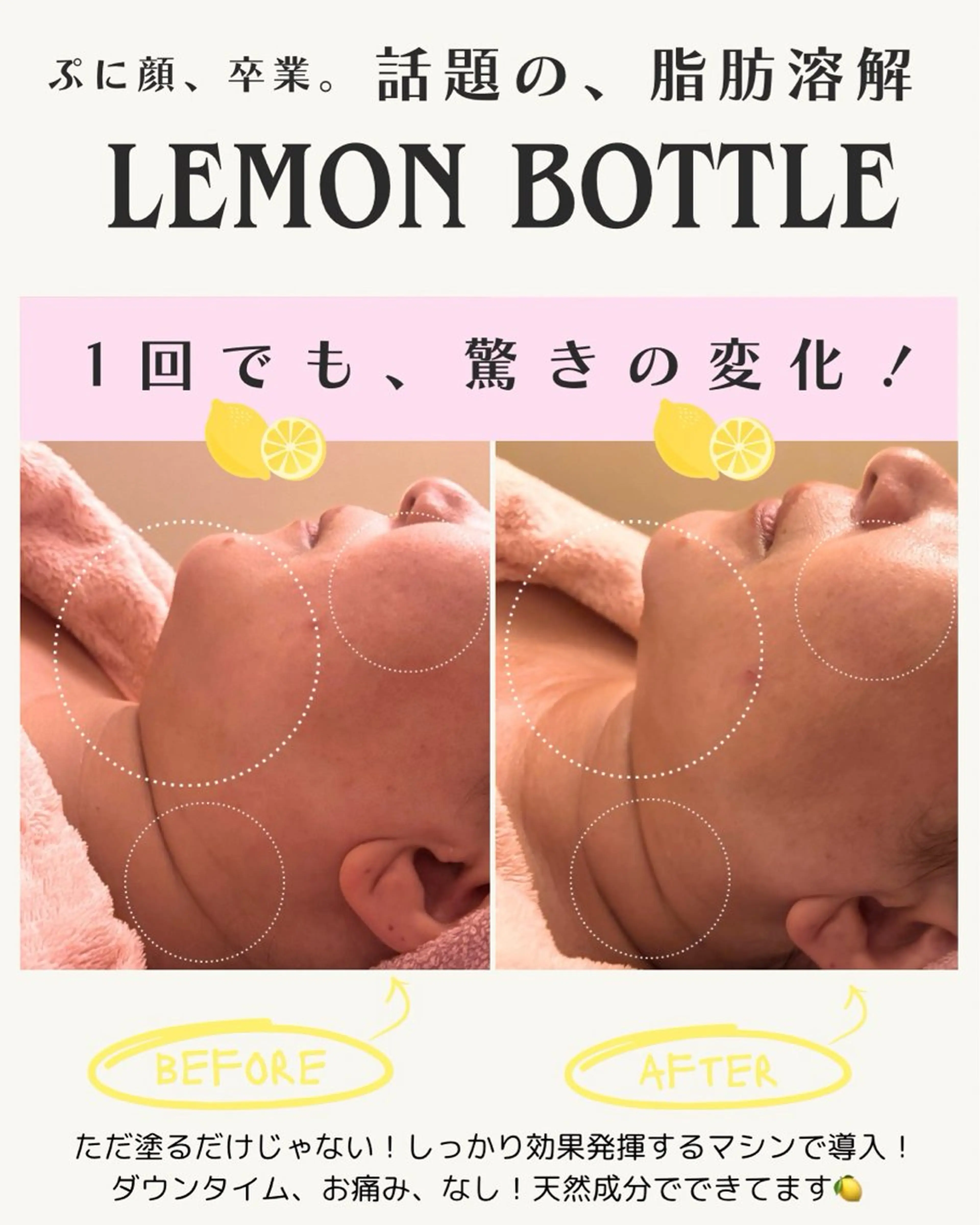 🇰🇷韓国最新🍋ボトル脂肪〇解🩷顔痩せ・小顔・口周りぽにょ・二重アゴ✨ダウンタイムなし🍐Before Afterの写真
