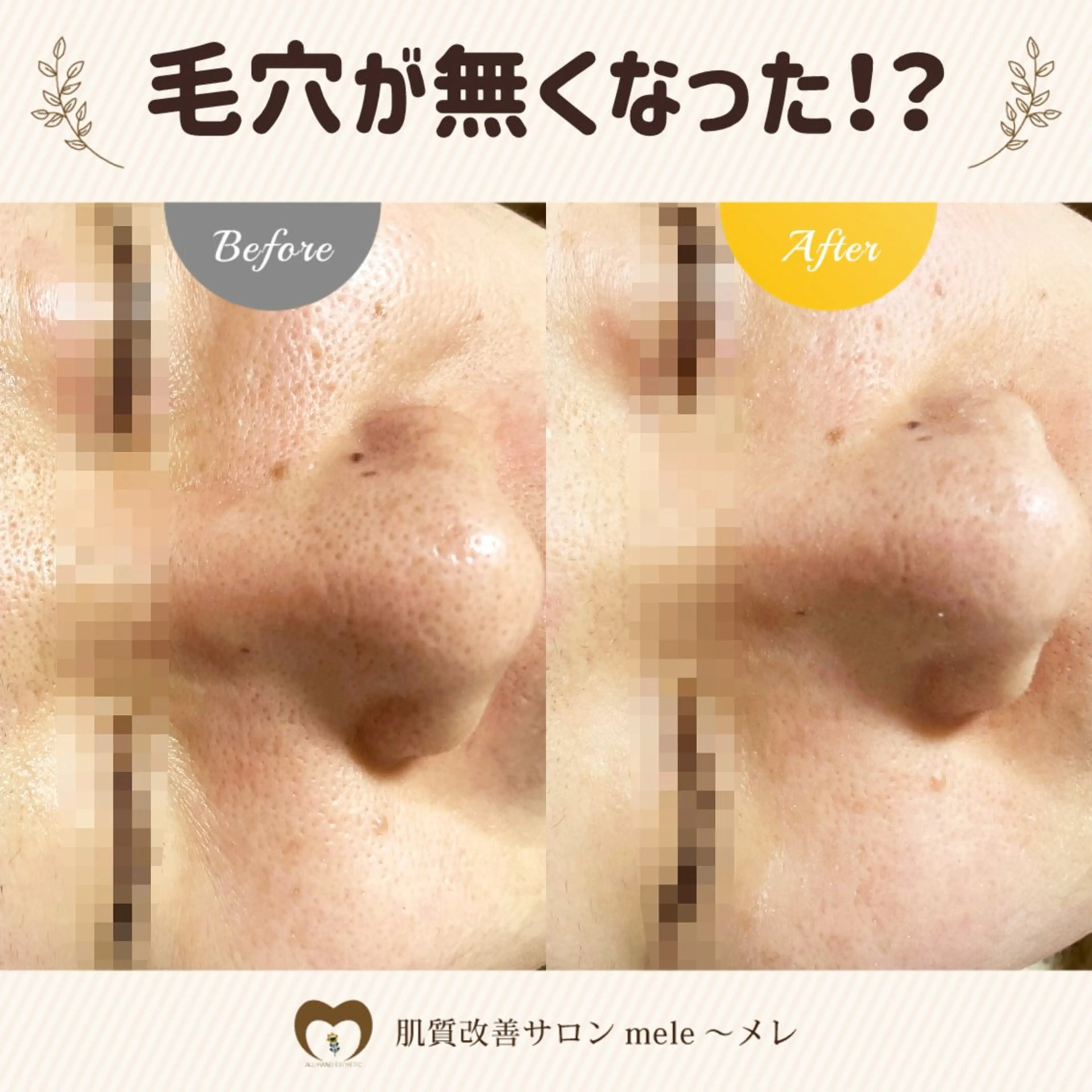 ニキビケア/毛穴/ 赤み/自信の肌✨森園のエステ・リラクイメージ