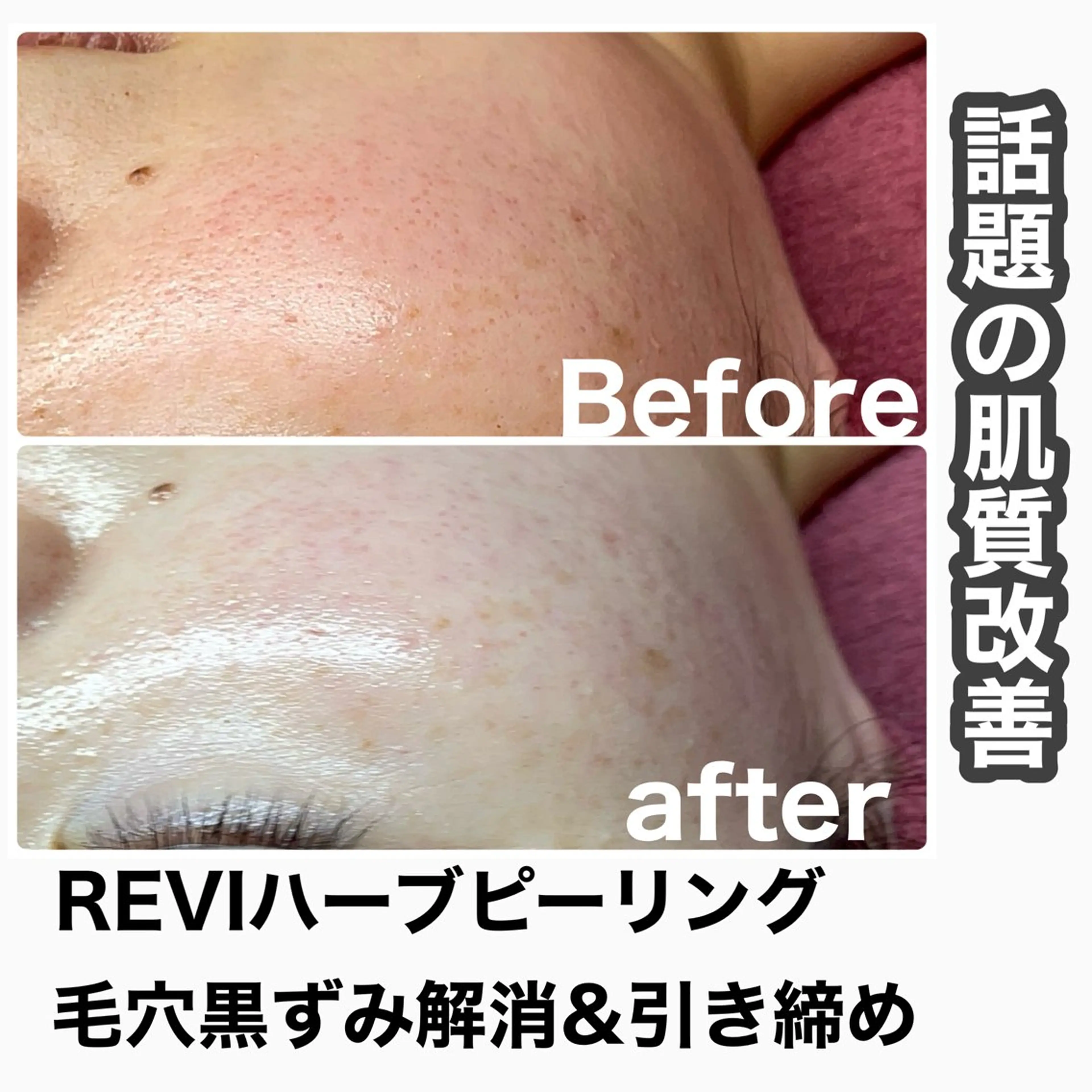 エステ Chalon所属・REVI取扱・肌悩み 改善　Chalonのエステ・リラクイメージ