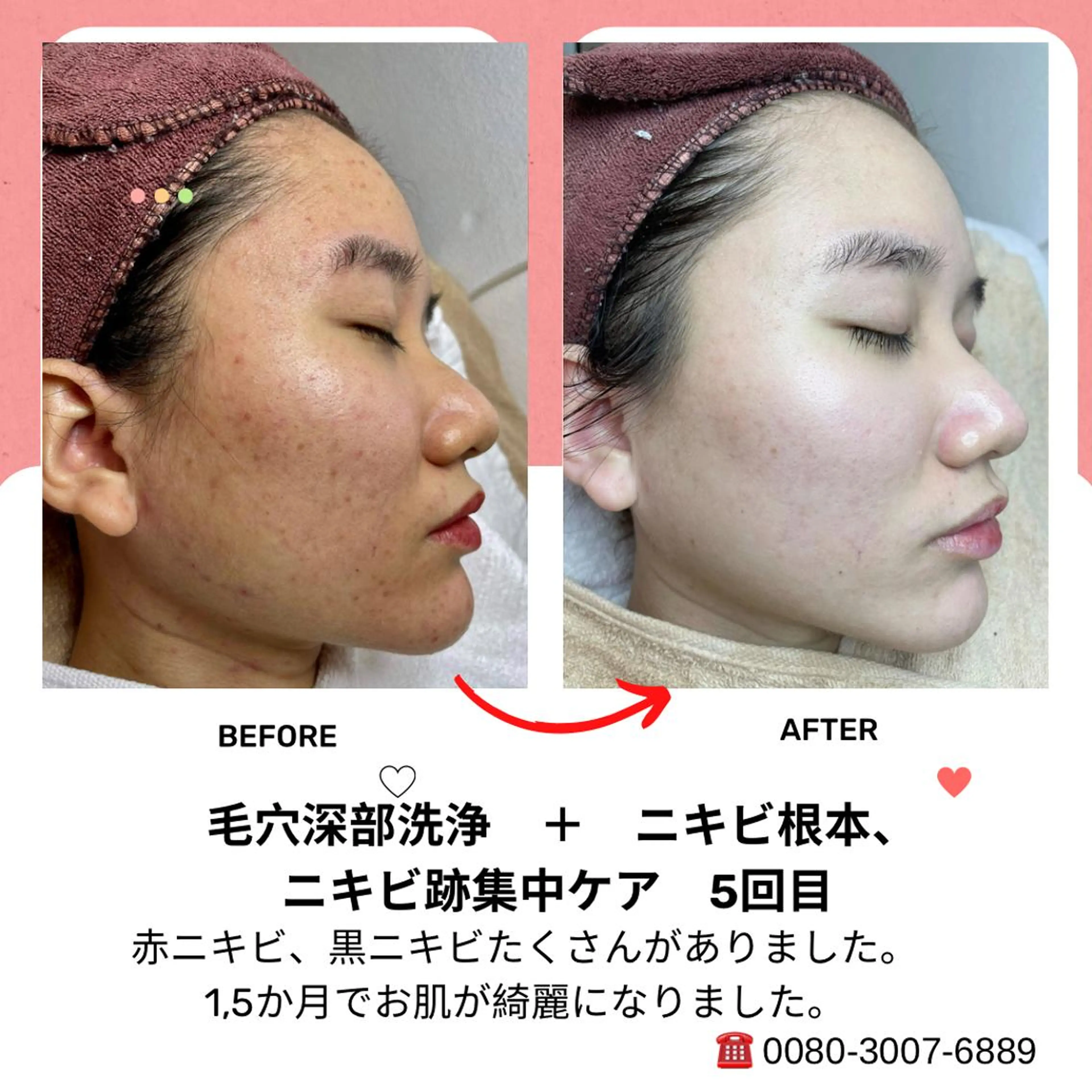 ニキビ、痩身、脱毛、 サクラチャンスパのエステ・リラクイメージ